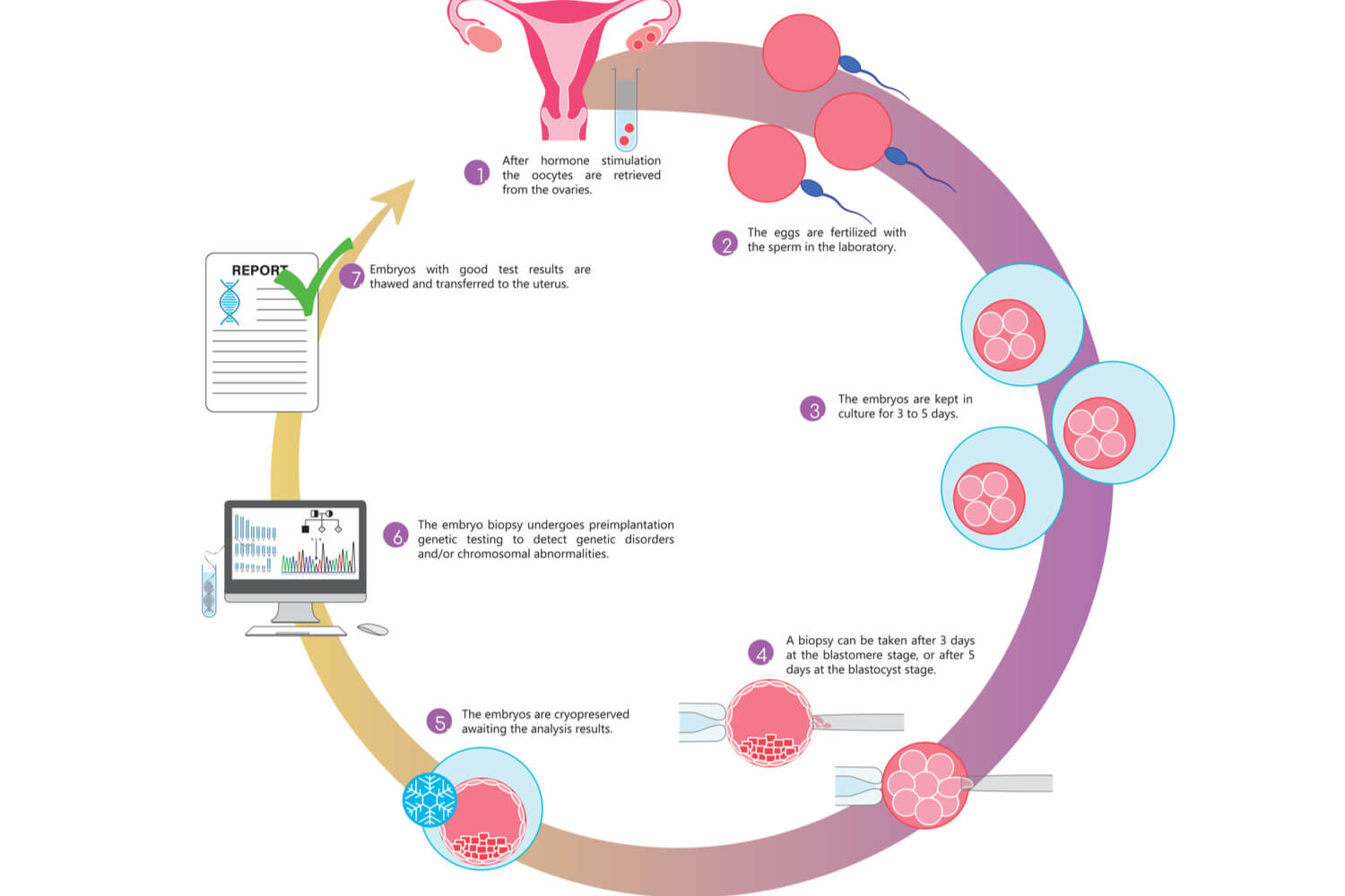  IVF cycle with preimplantation genetic testing