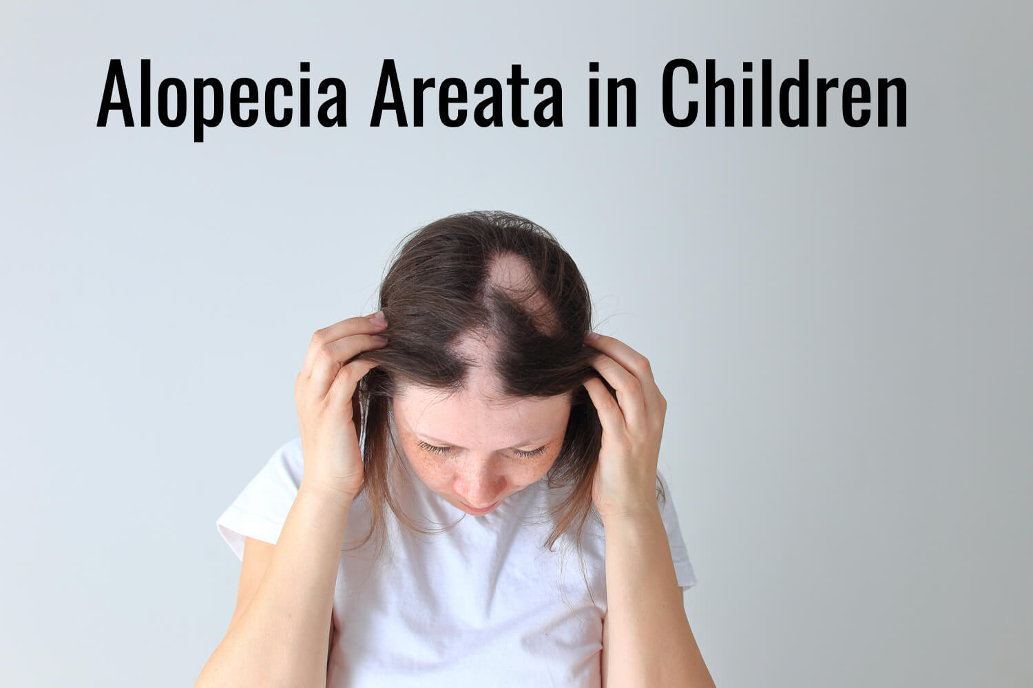 Alopecia Areata in Children Causes & Treatment Being The Parent