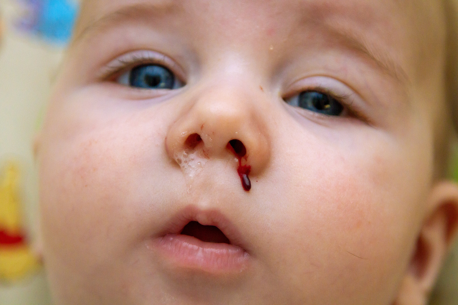 Baby's nose bleeding