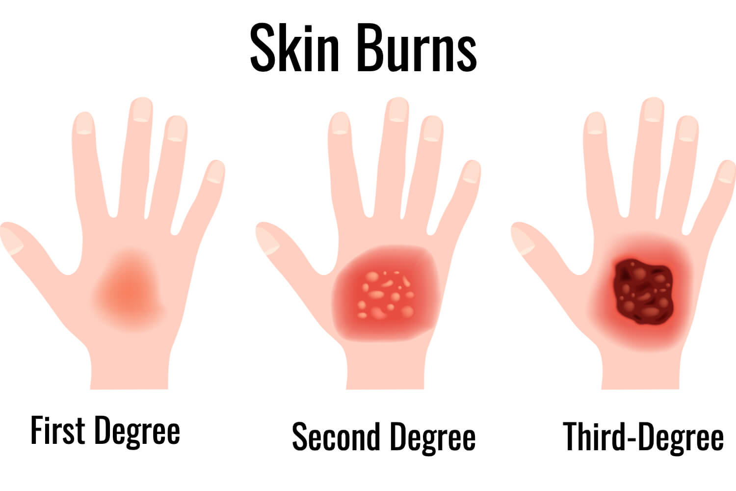 skin burn types