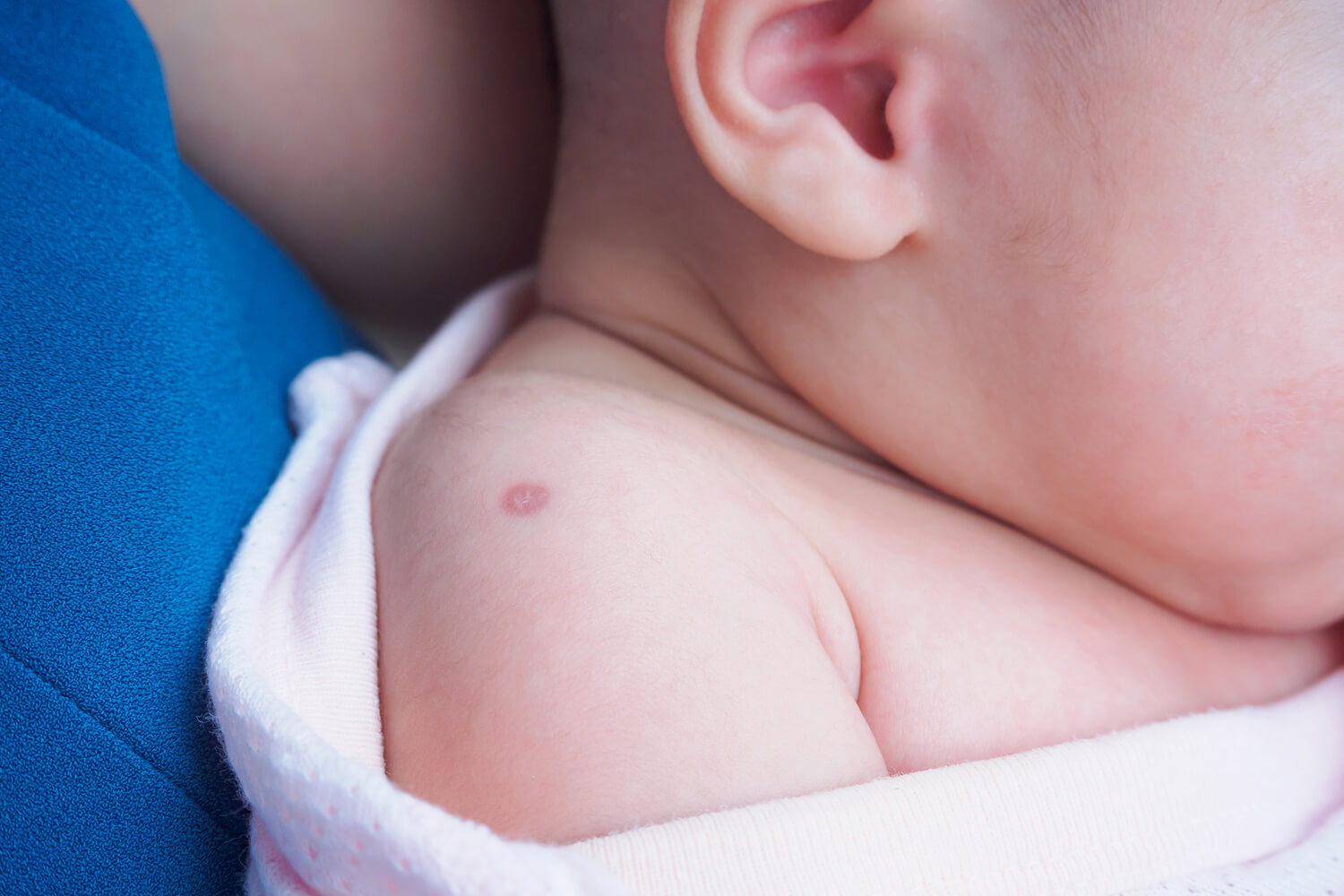 BCG vaccine scar on baby