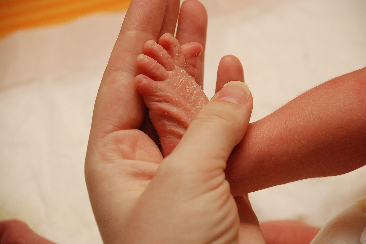Dry Skin In Babies Causes, Symptoms And Ways To Prevent