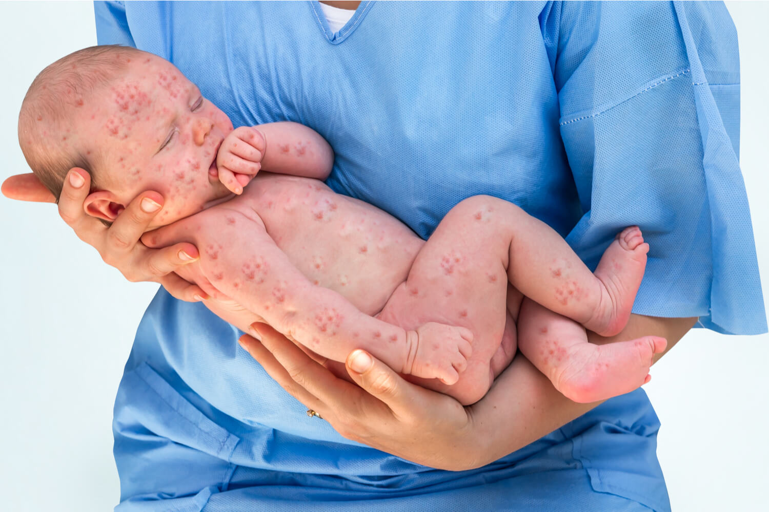newborn baby having chickenpox