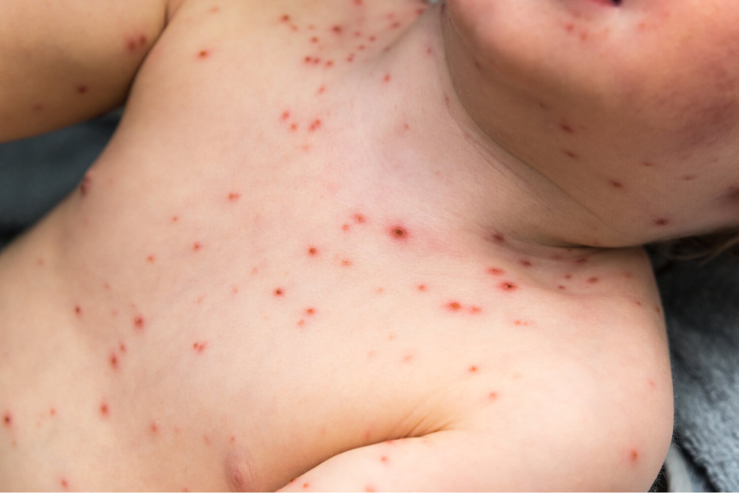 picture of chicken pox in baby