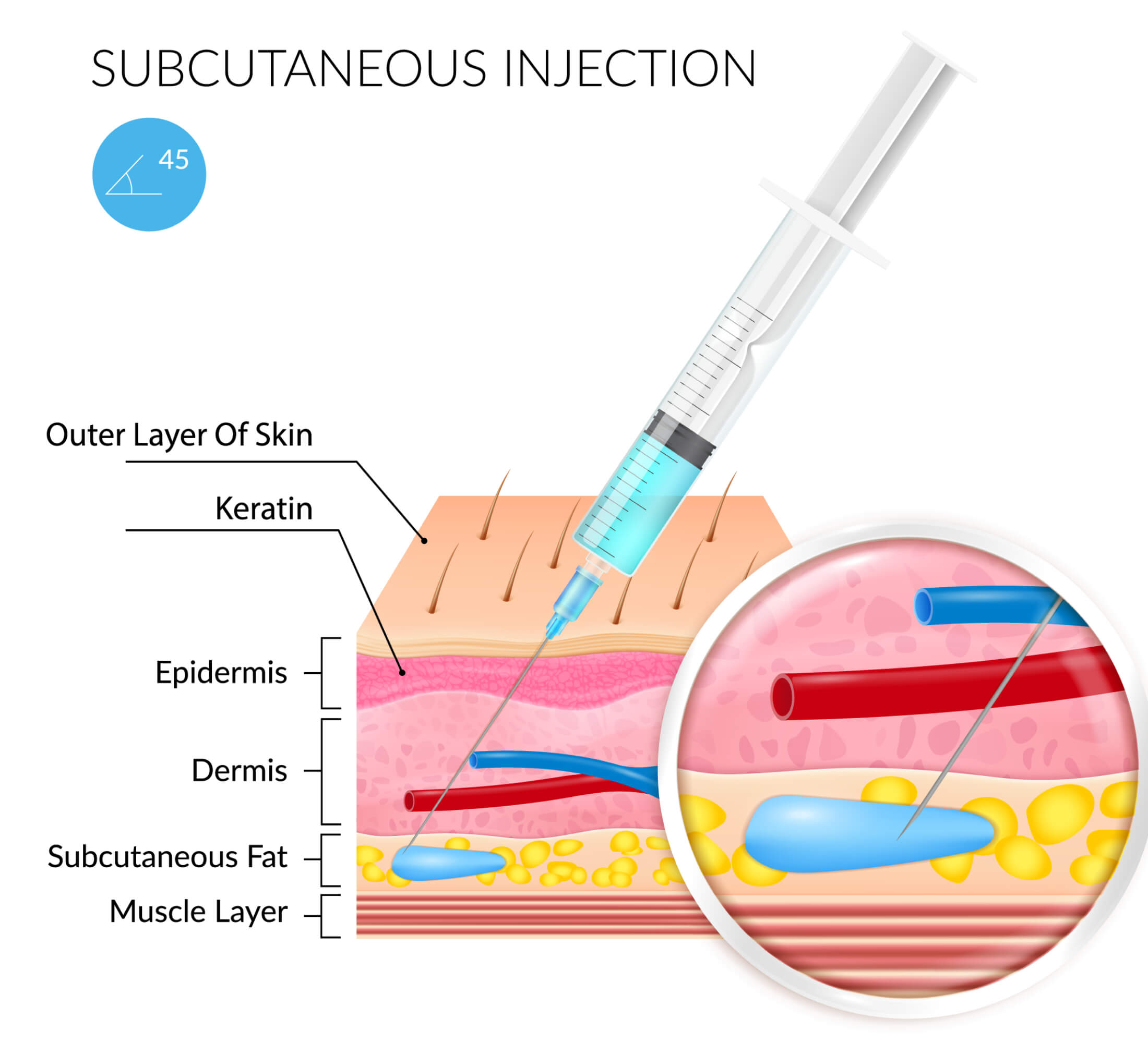 Subcutaneous immunoglobulin injection