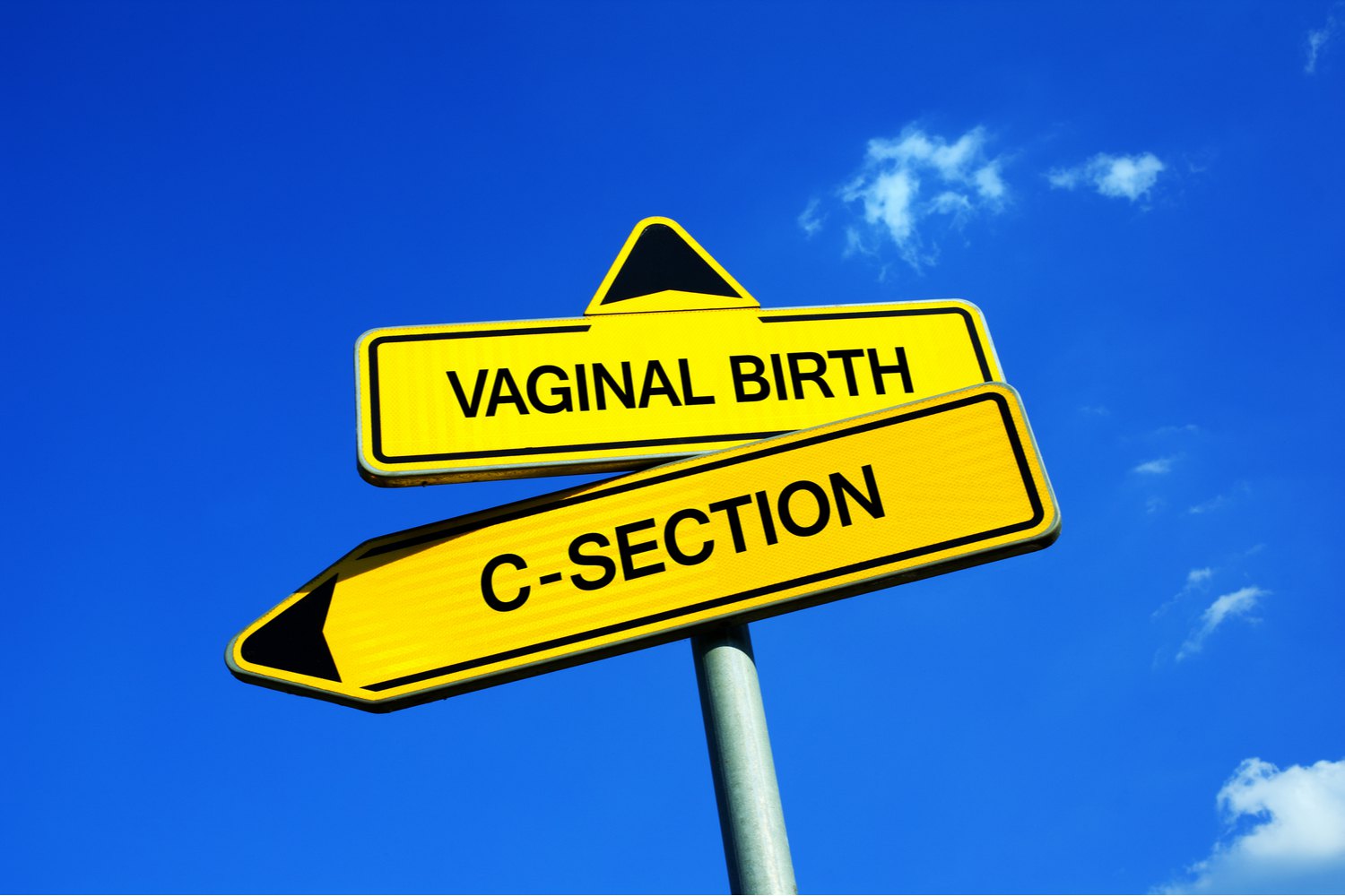 Vaginal or Caesarean Birth_