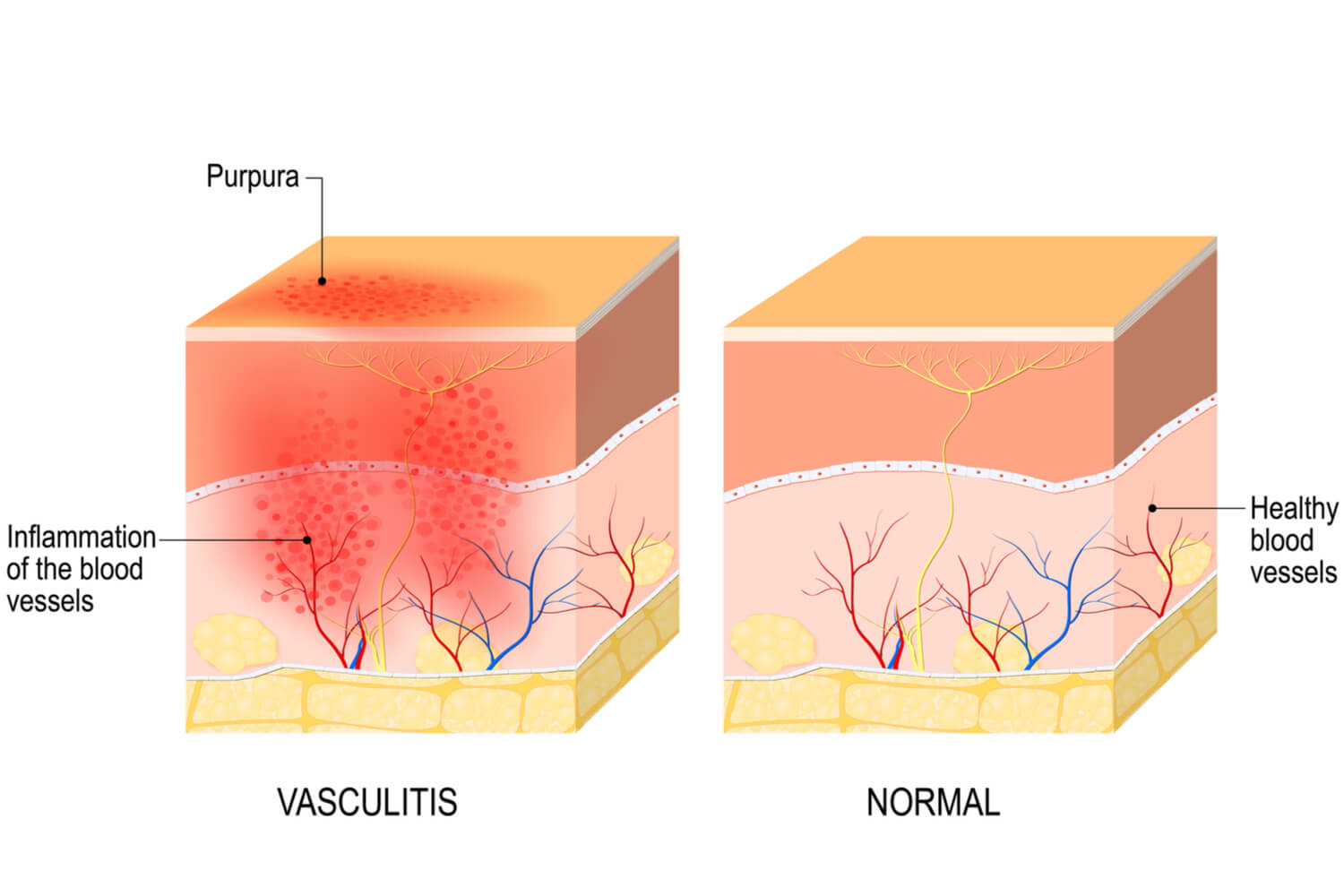 Vasculitis -type of Connective Tissue disorder