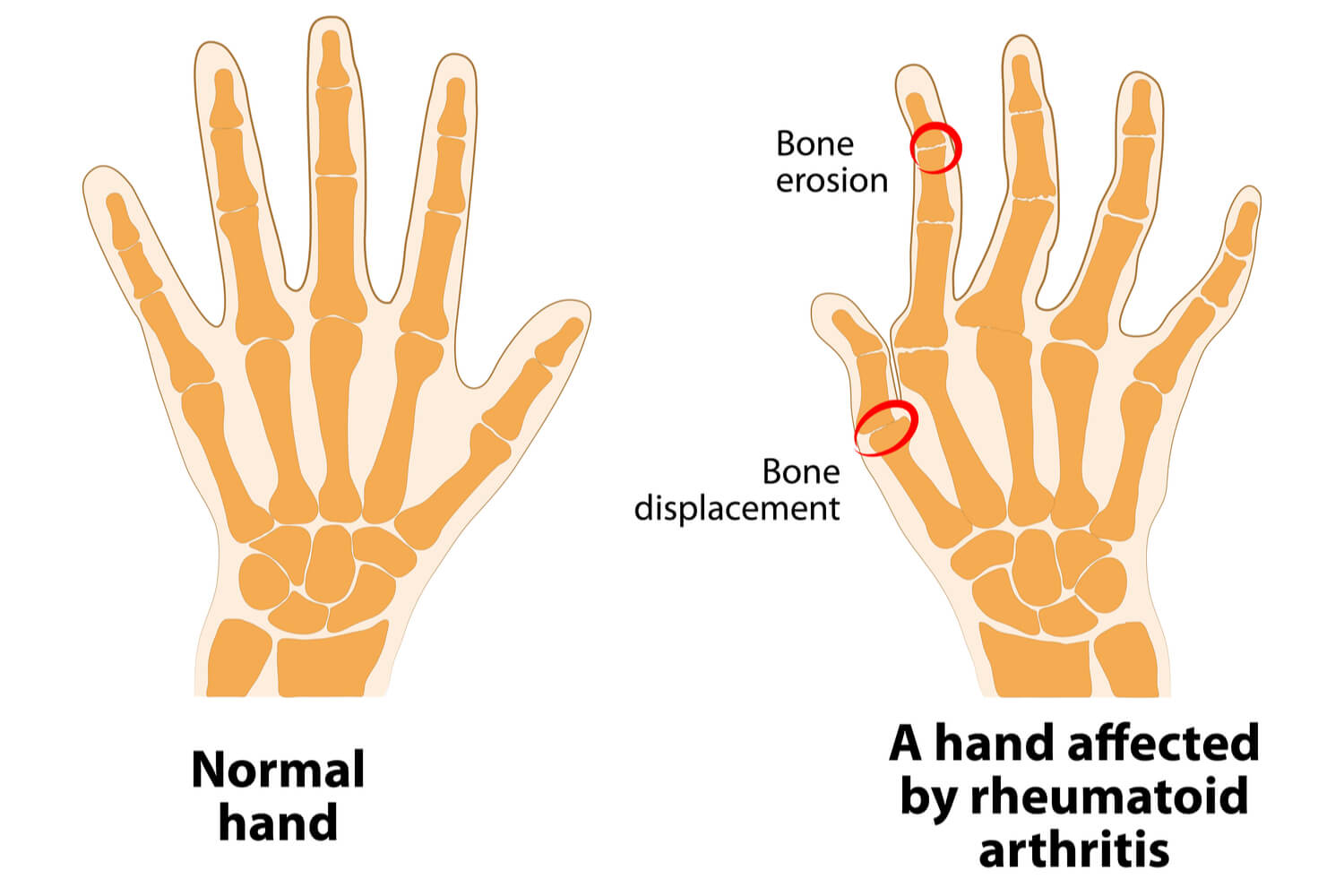 hand affected with Rheumatoid Arthritis