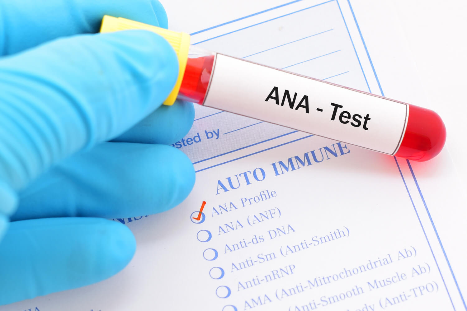 ANA test to Diagnose Lupus