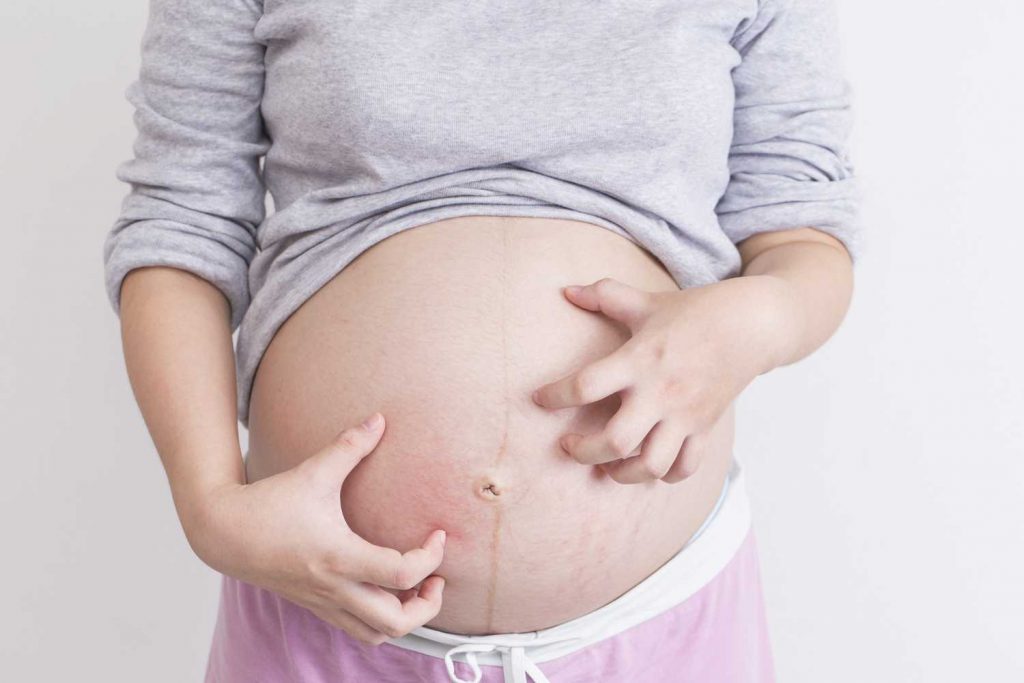 Itching During Pregnancy Causes, Home Treatment and When to See a