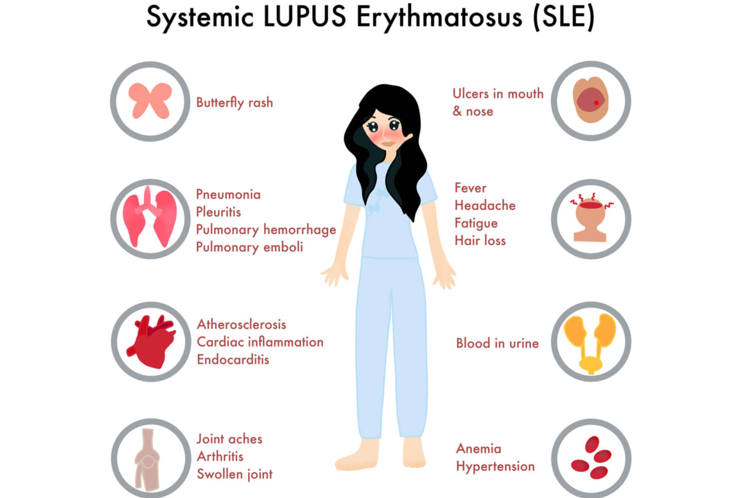 Symptoms of Systemic Lupus Erythematosus in Children