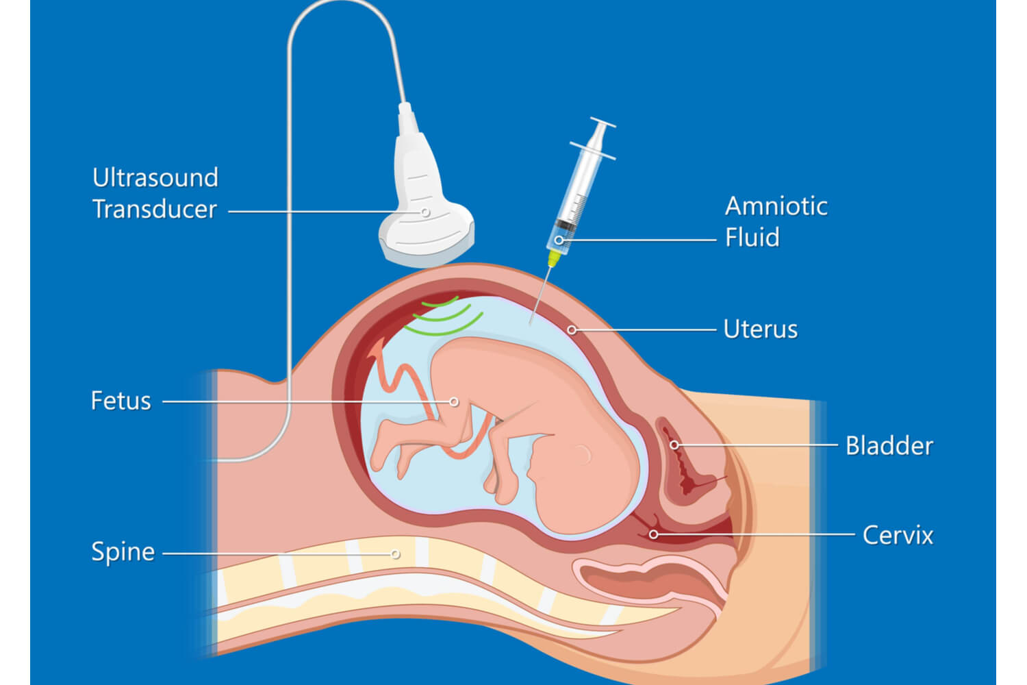 Amniocentesis test