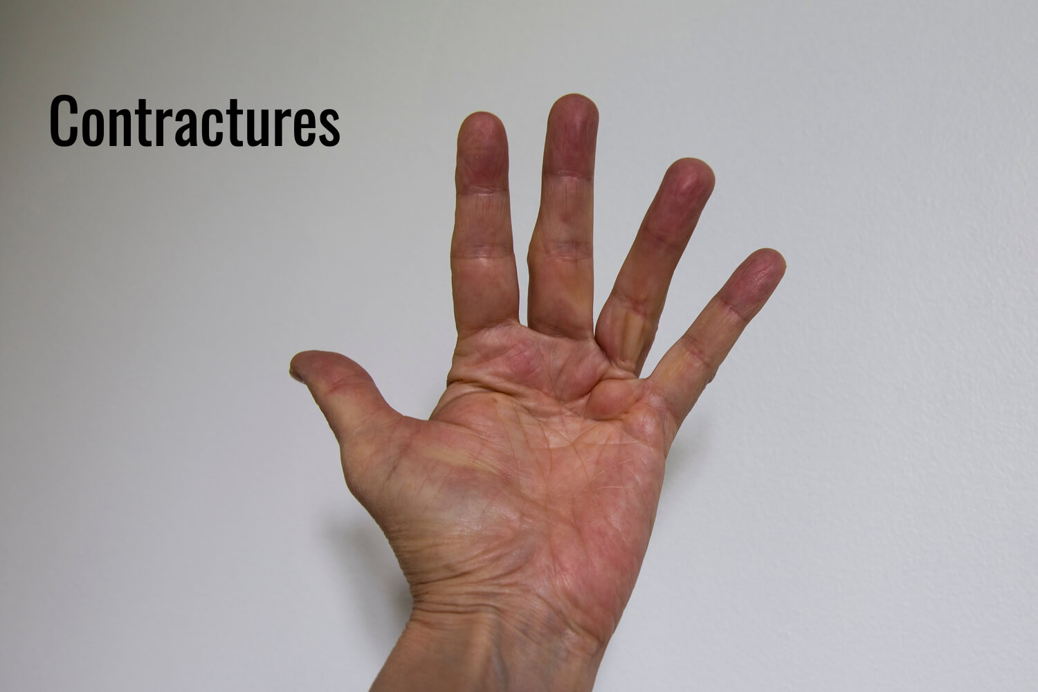 Contractures