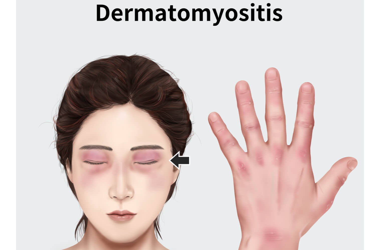 cause of Dermatomyositis