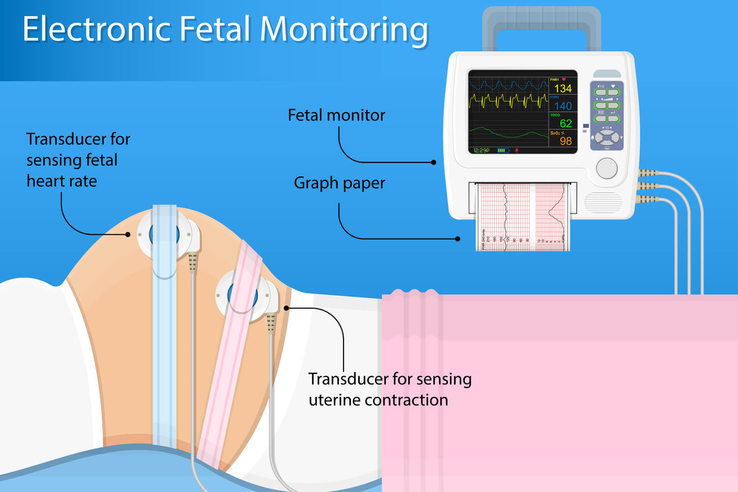 Electronic Fetal Monitoring procedure