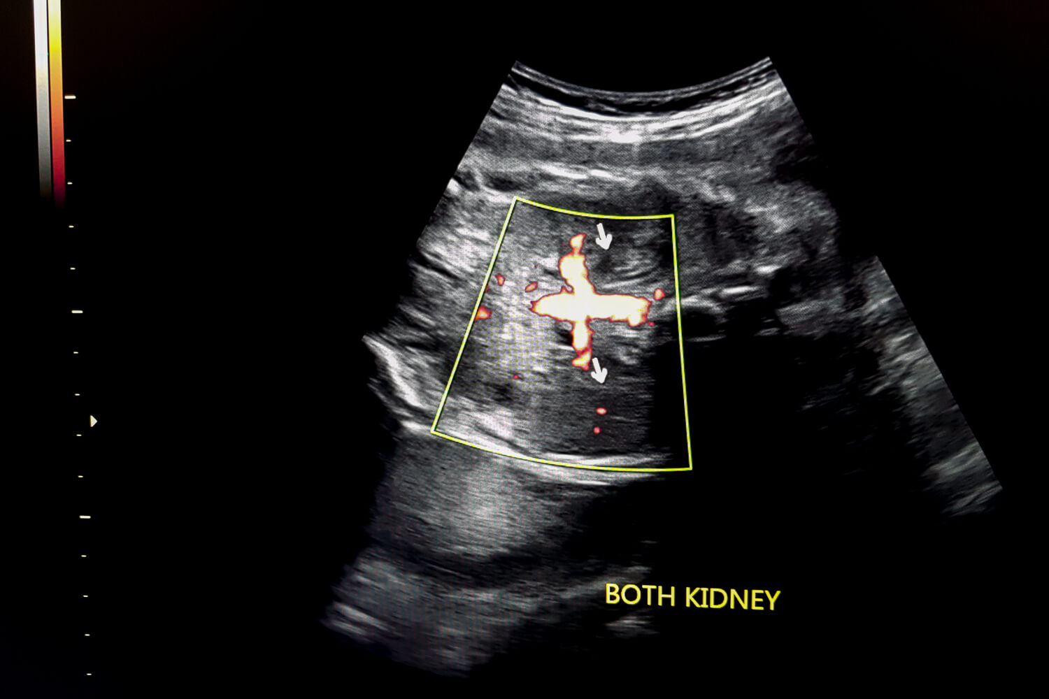 Fetal Kidney