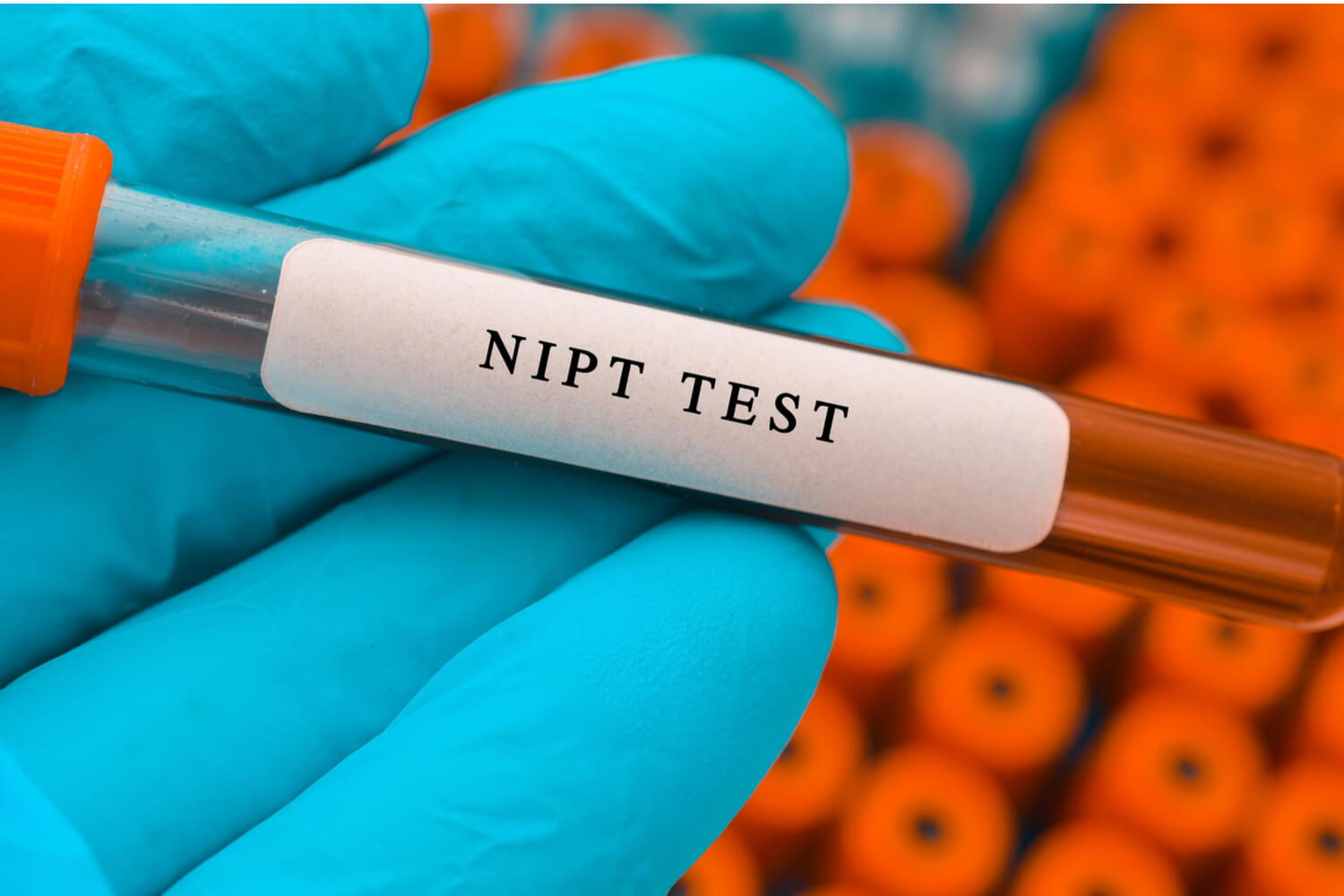 Нон спид. NIPT (non-invasive Prenatal Testing). Prenatal Screening Test.