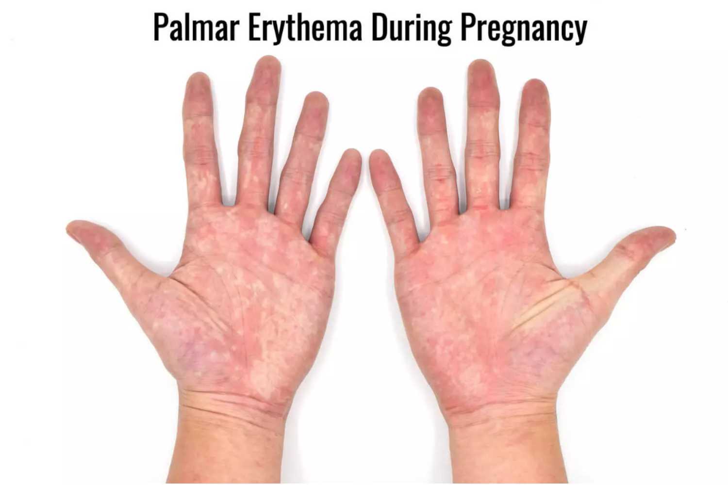 Palmar Erythema during pregnancy
