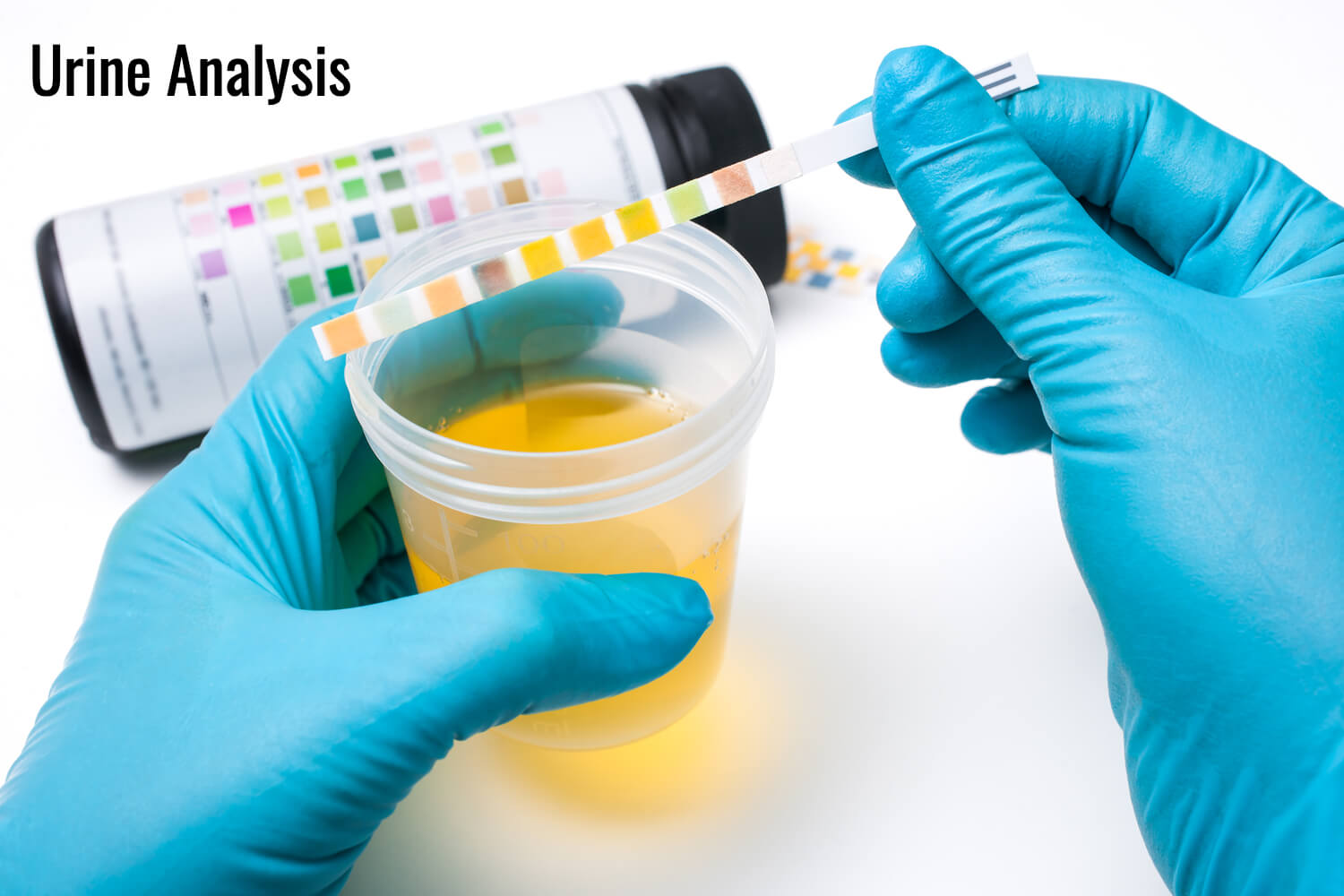 Urine Analysis -treatment for HSP