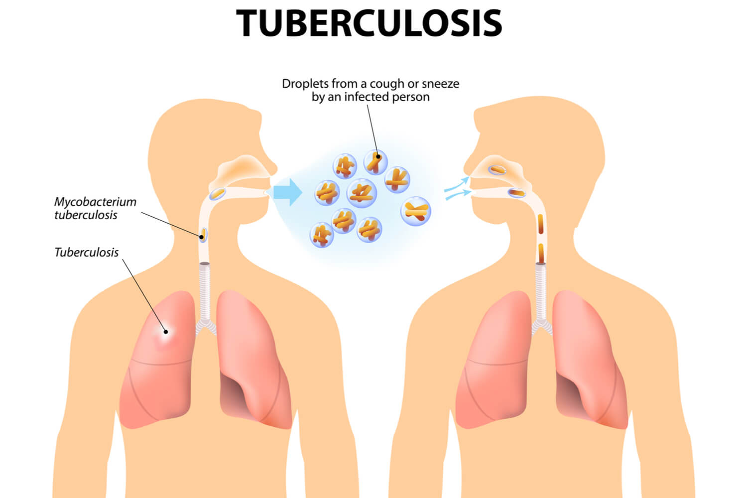 cause of TB