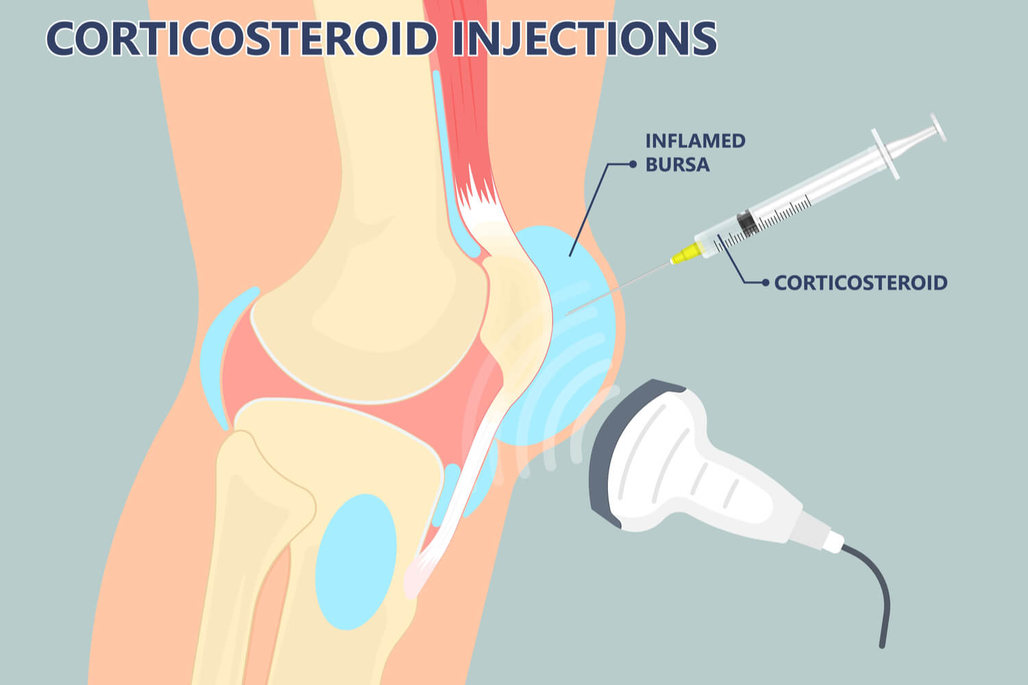 Corticosteroids injection