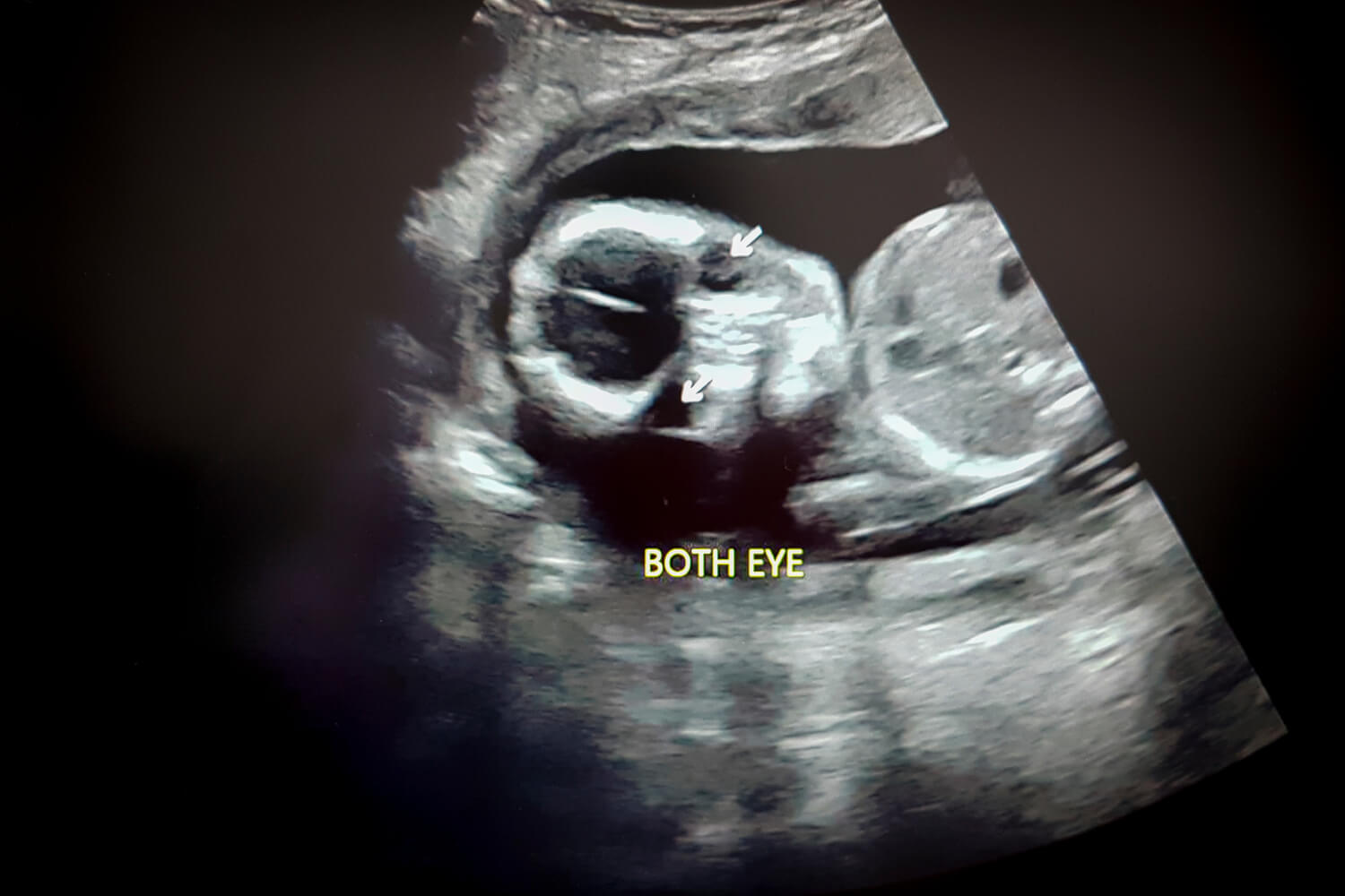 eyes in ultrasound