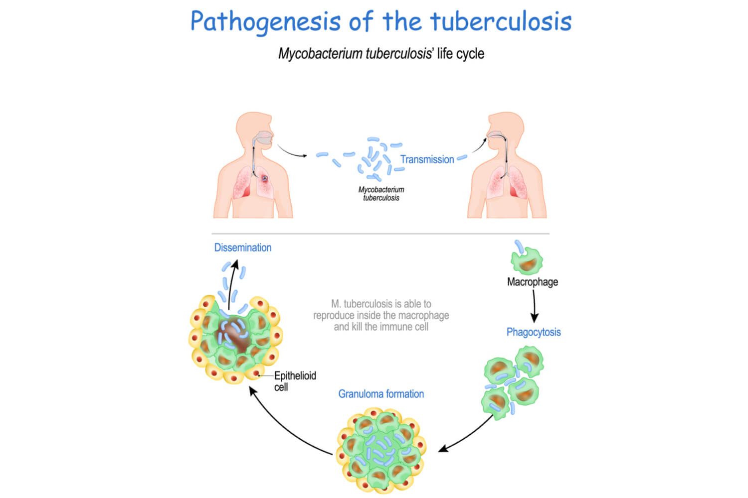 Progression of Tuberculosis in Children