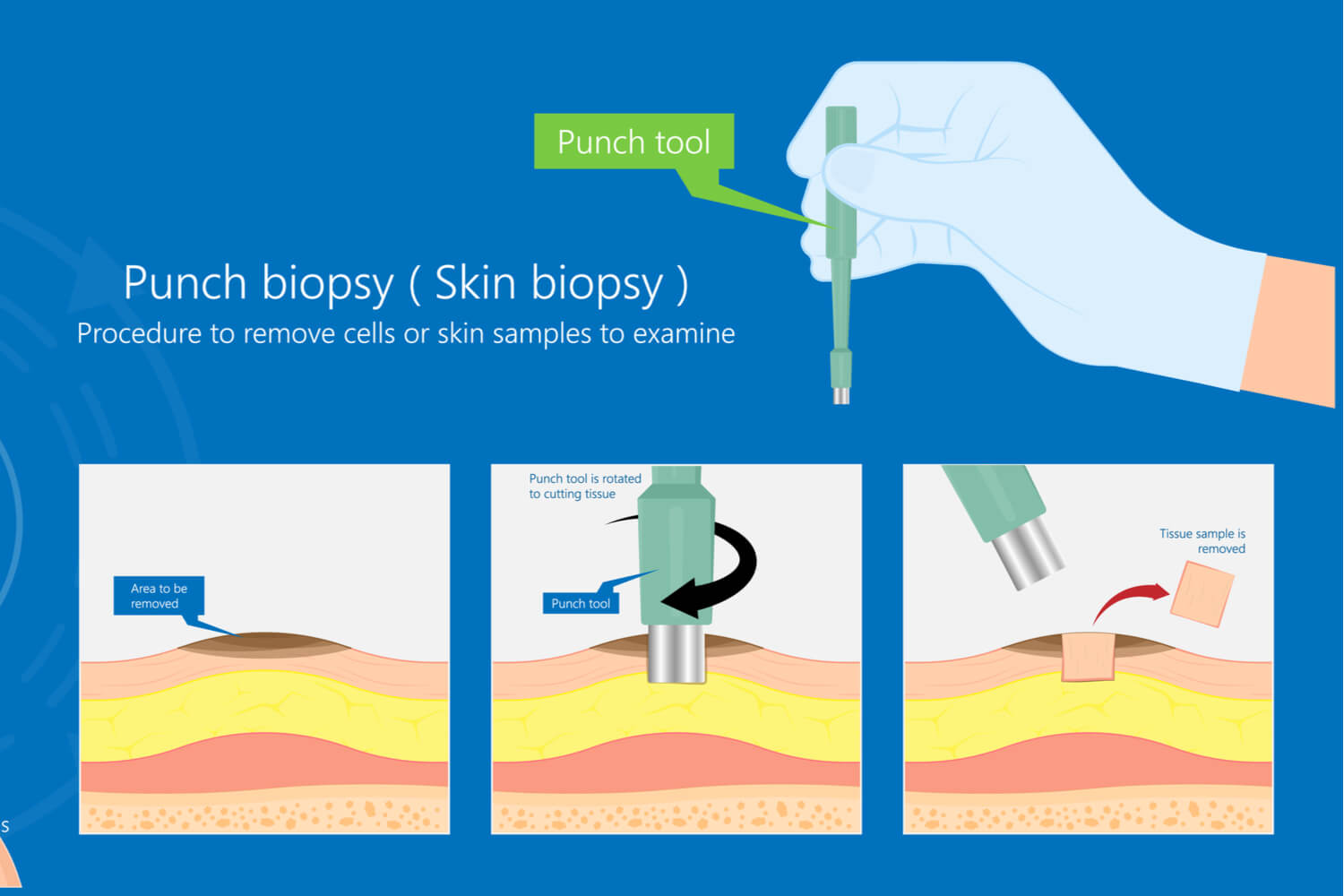 skin biopsy