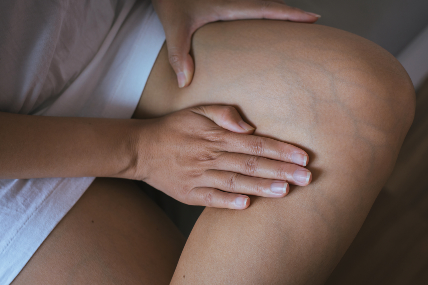 Pregnant Woman With Varicose Veins
