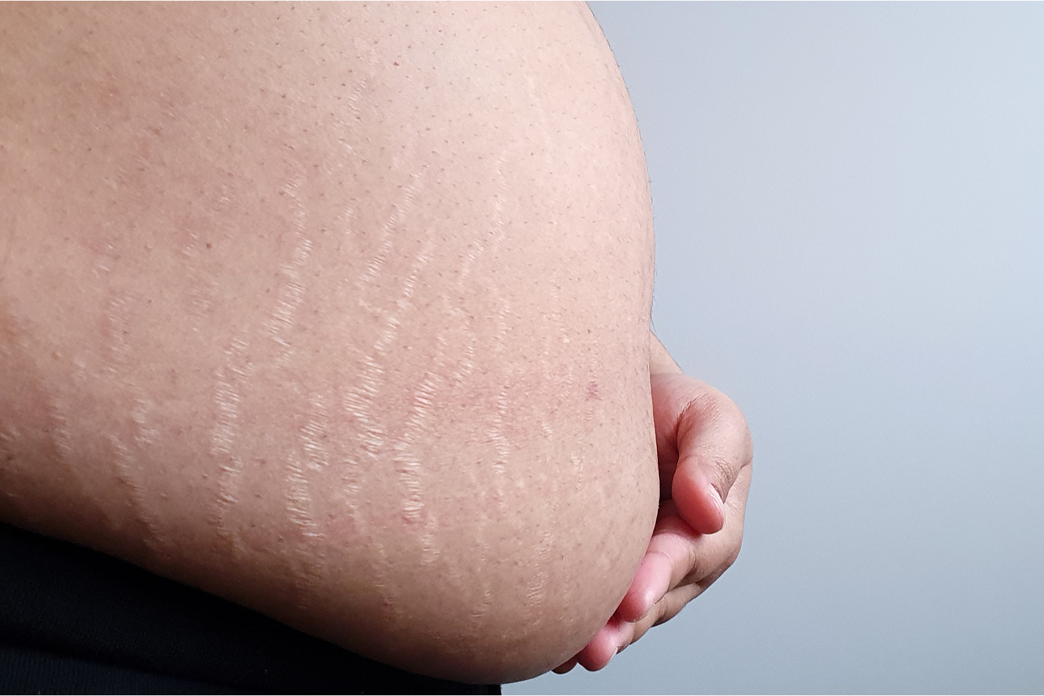 Woman With Pregnancy Strech Marks