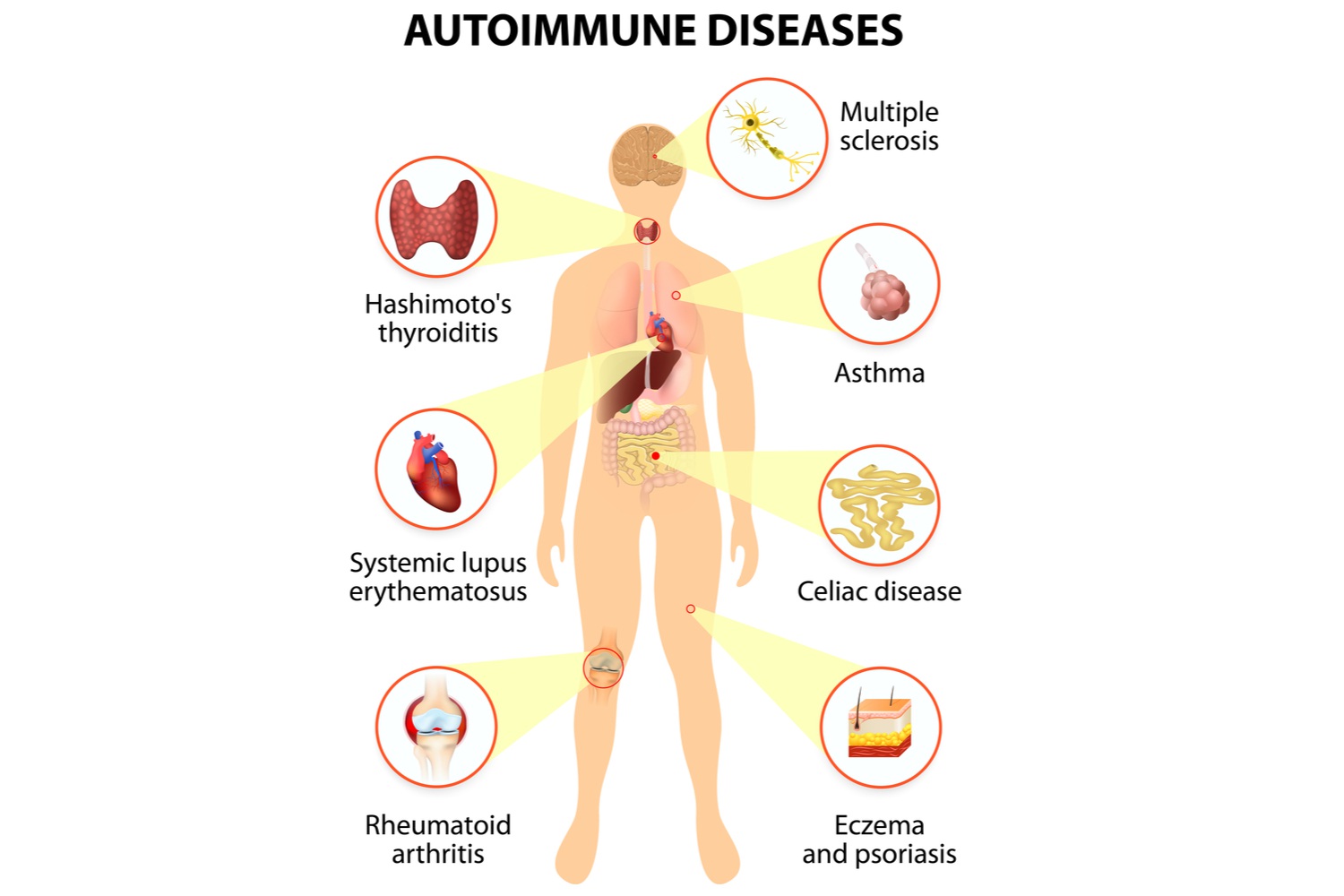 What are Autoimmune Diseases