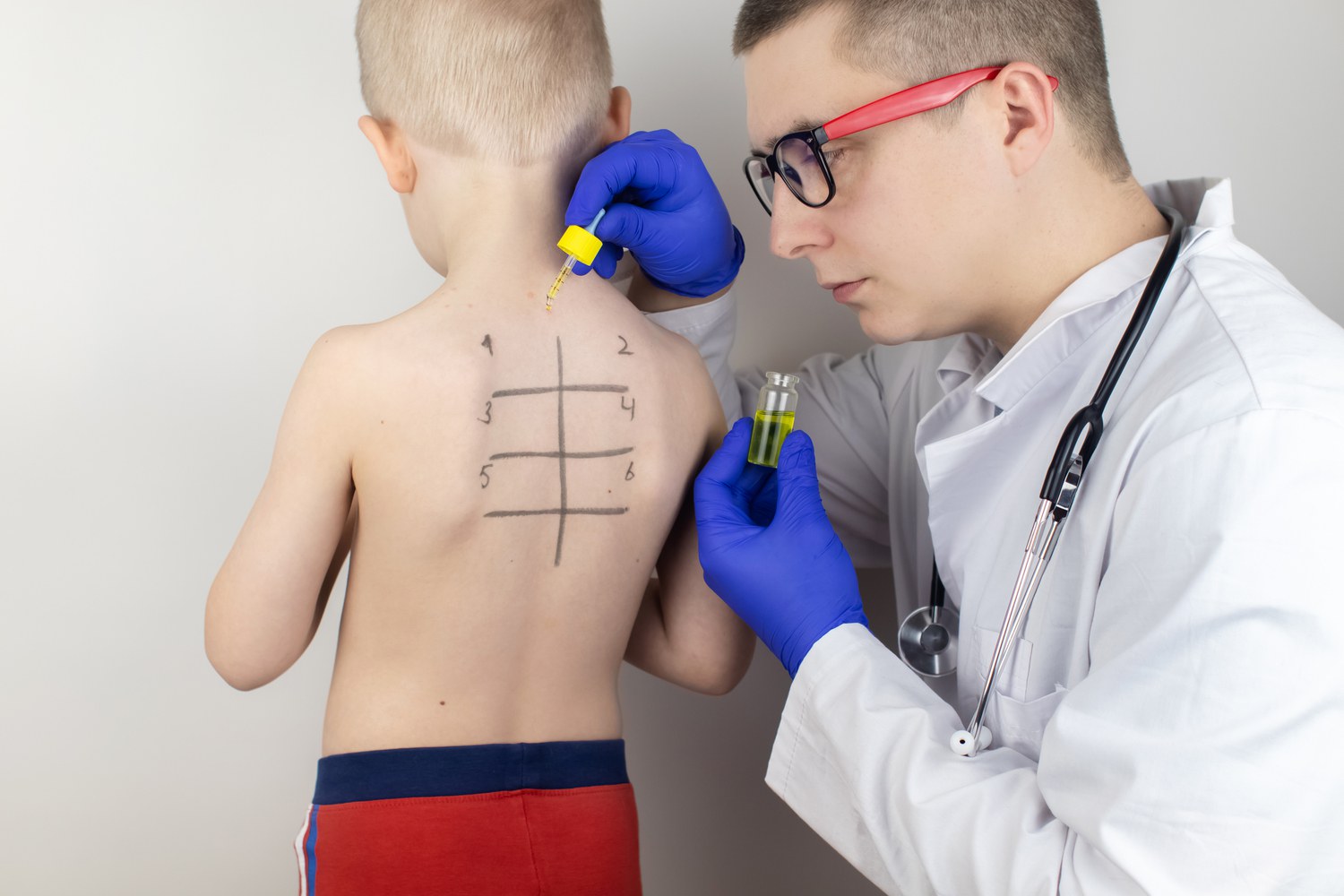 Procedure For a Skin Prick Test in Children