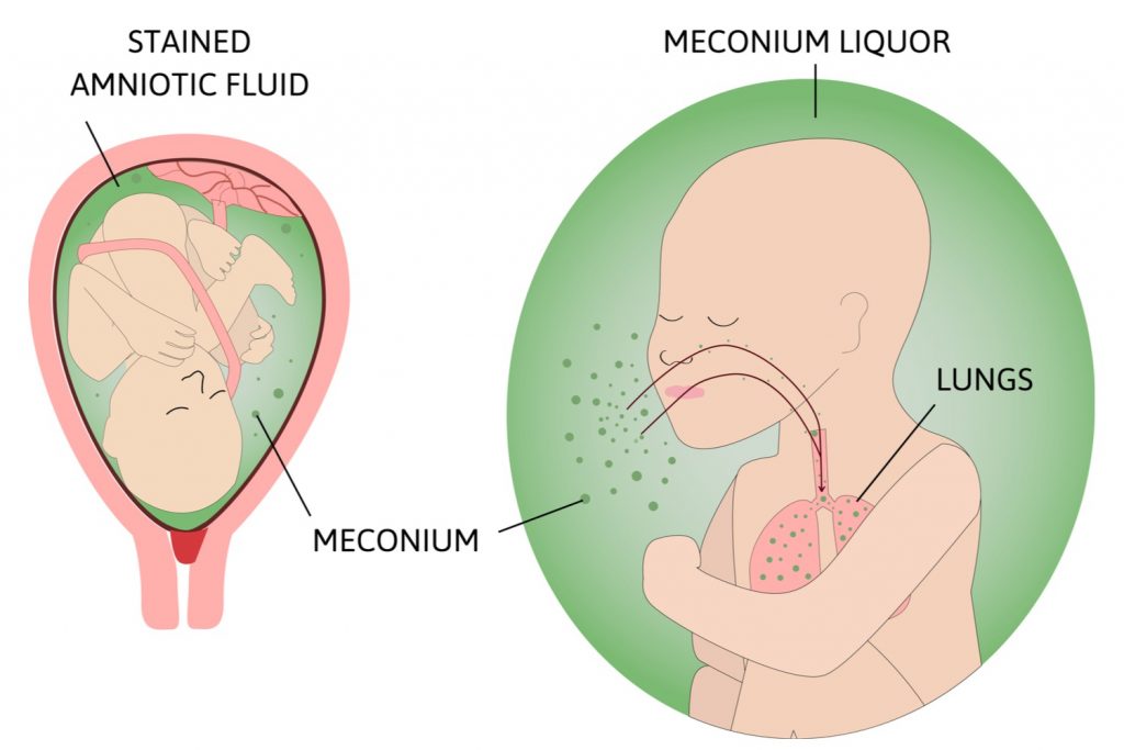Understanding Meconium Aspiration Syndrome in Babies