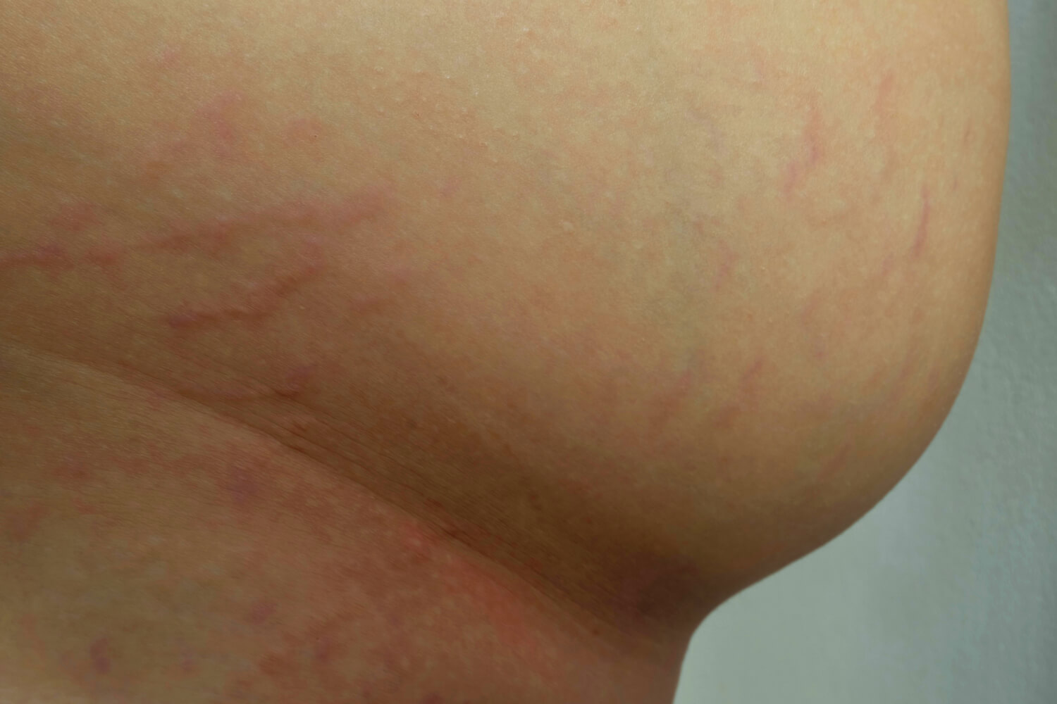 Signs And Symptoms of PUPPP Rash During Pregnancy