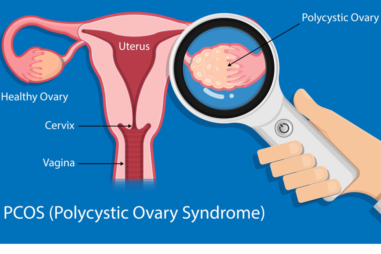 Secondary infertility and PCOS