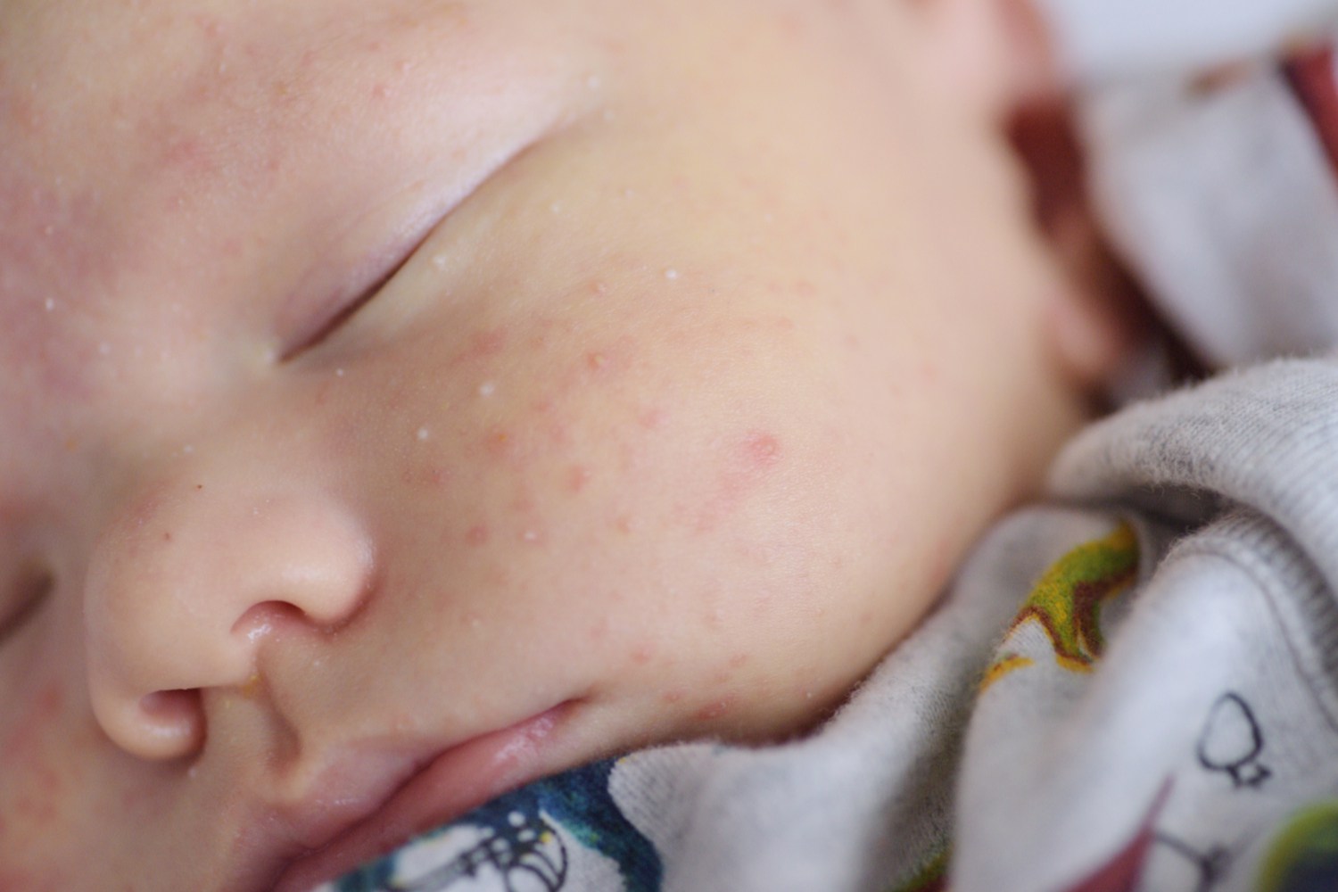 Signs And Symptoms of Erythema Toxicum Neonatorum in Newborns