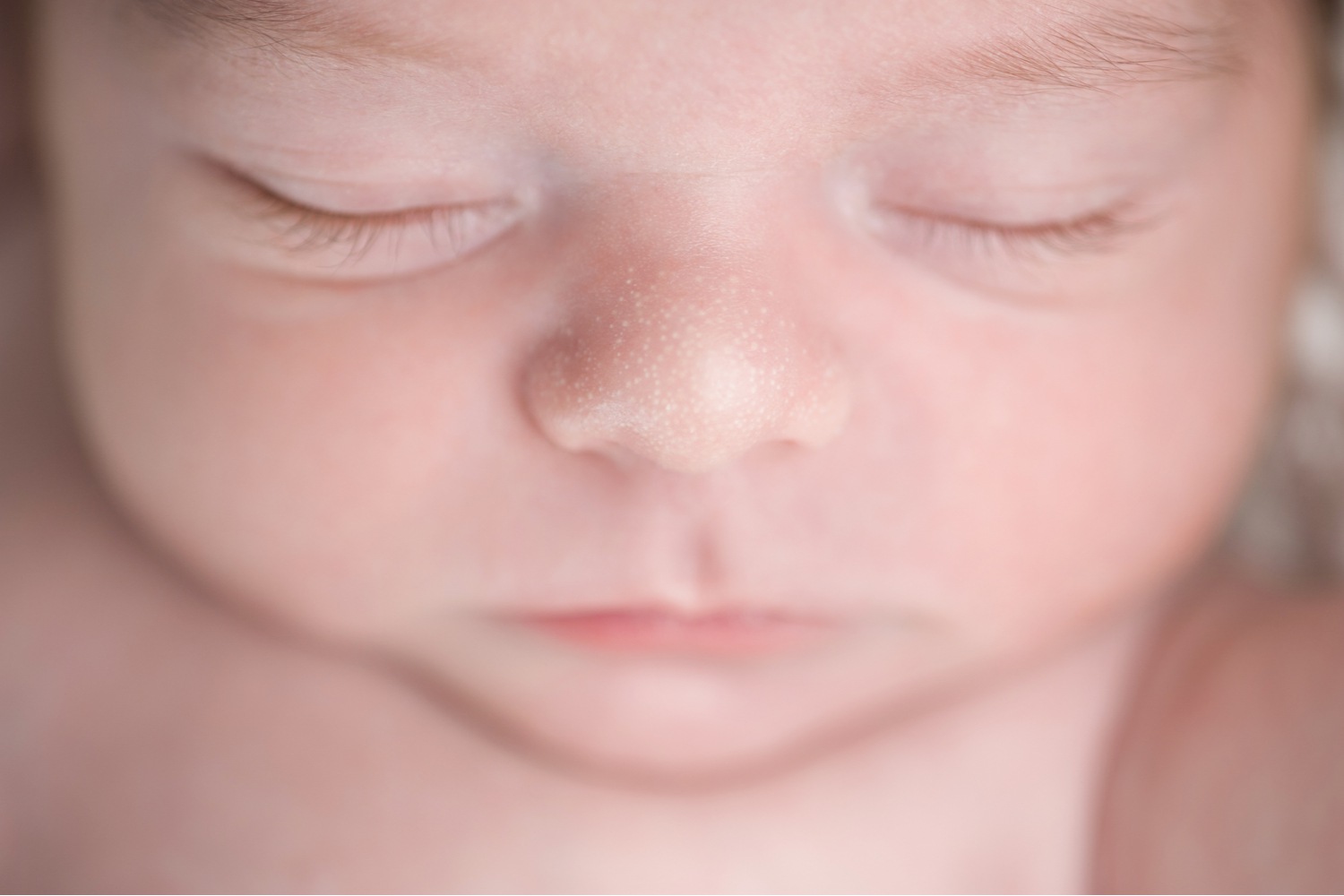 Symptoms of Milia in Newborn Babies