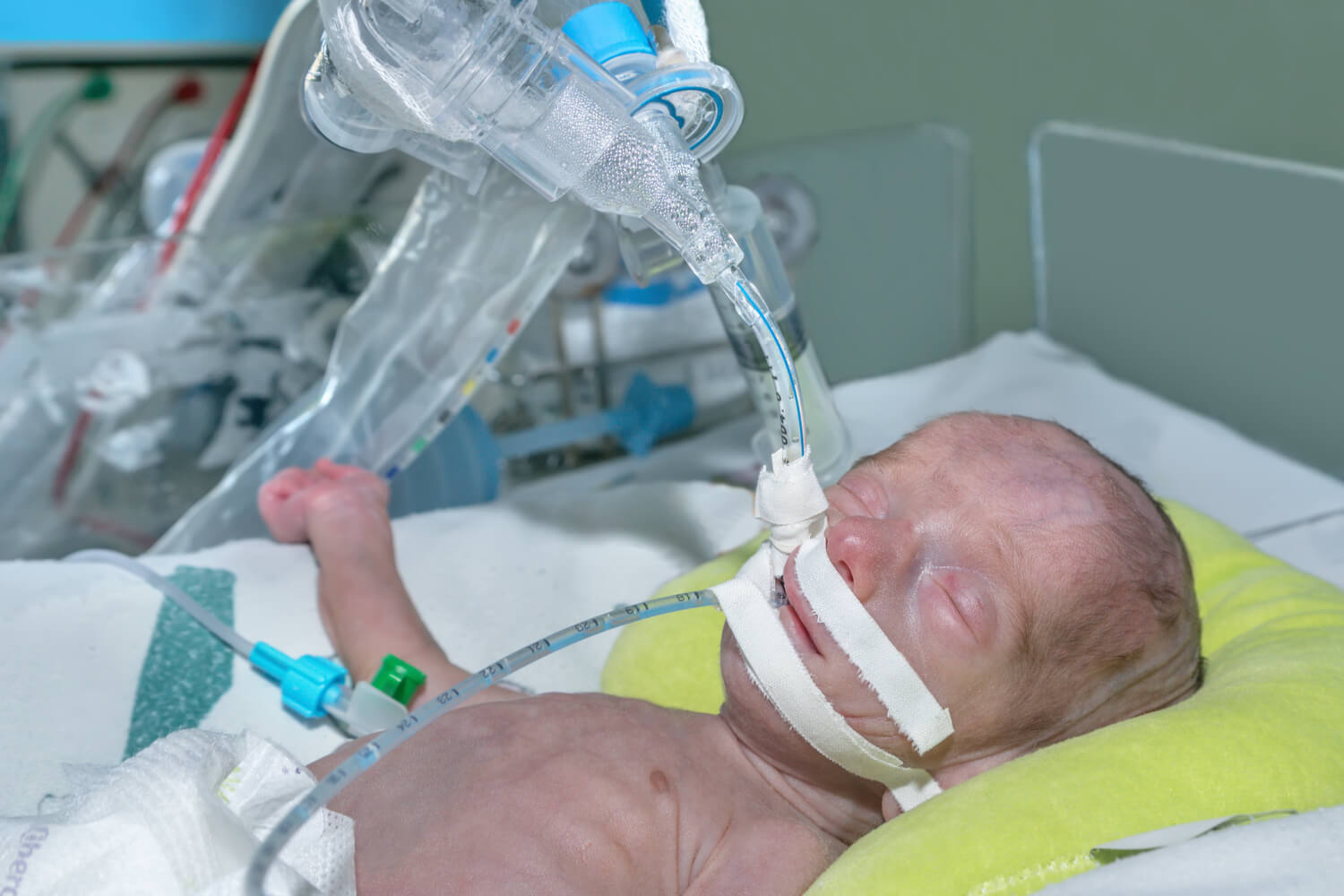 Birth Asphyxia Signs, Causes, Diagnosis and Treatment by Dr Lathiesh