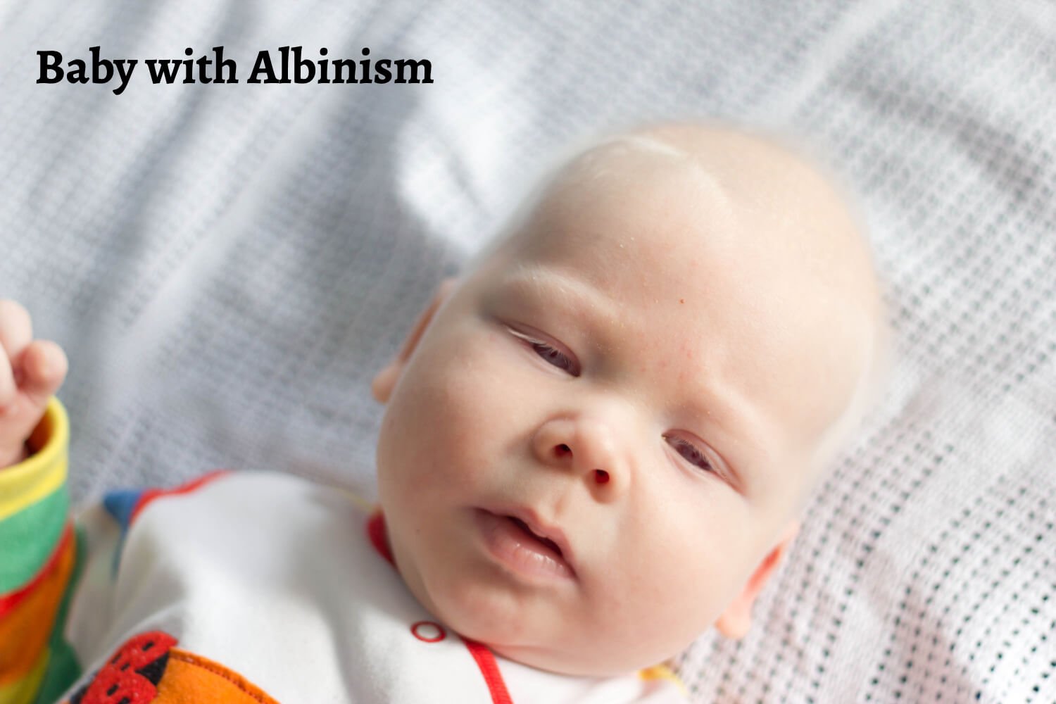 baby with Albinism