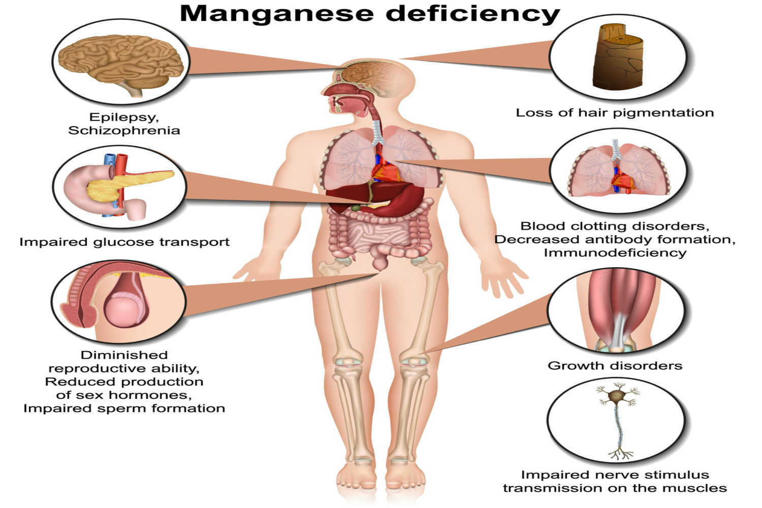 Manganese Deficiency in Babies