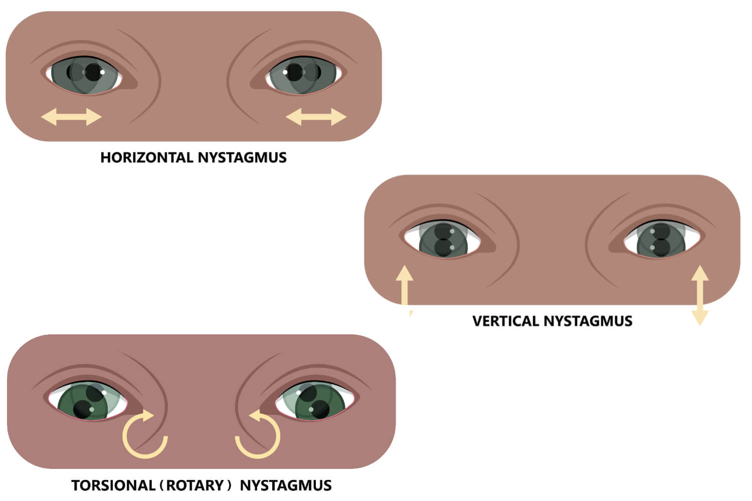 Congenital Nystagmus in Babies Causes, Symptoms And Treatment Being