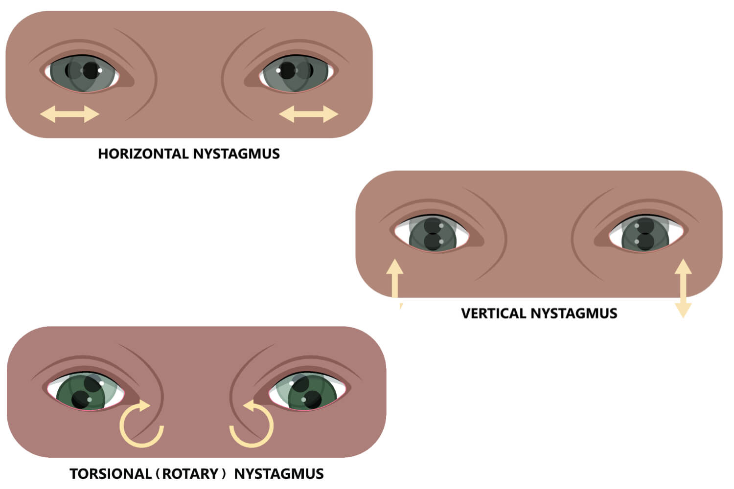 Types of Congenital Nystagmus