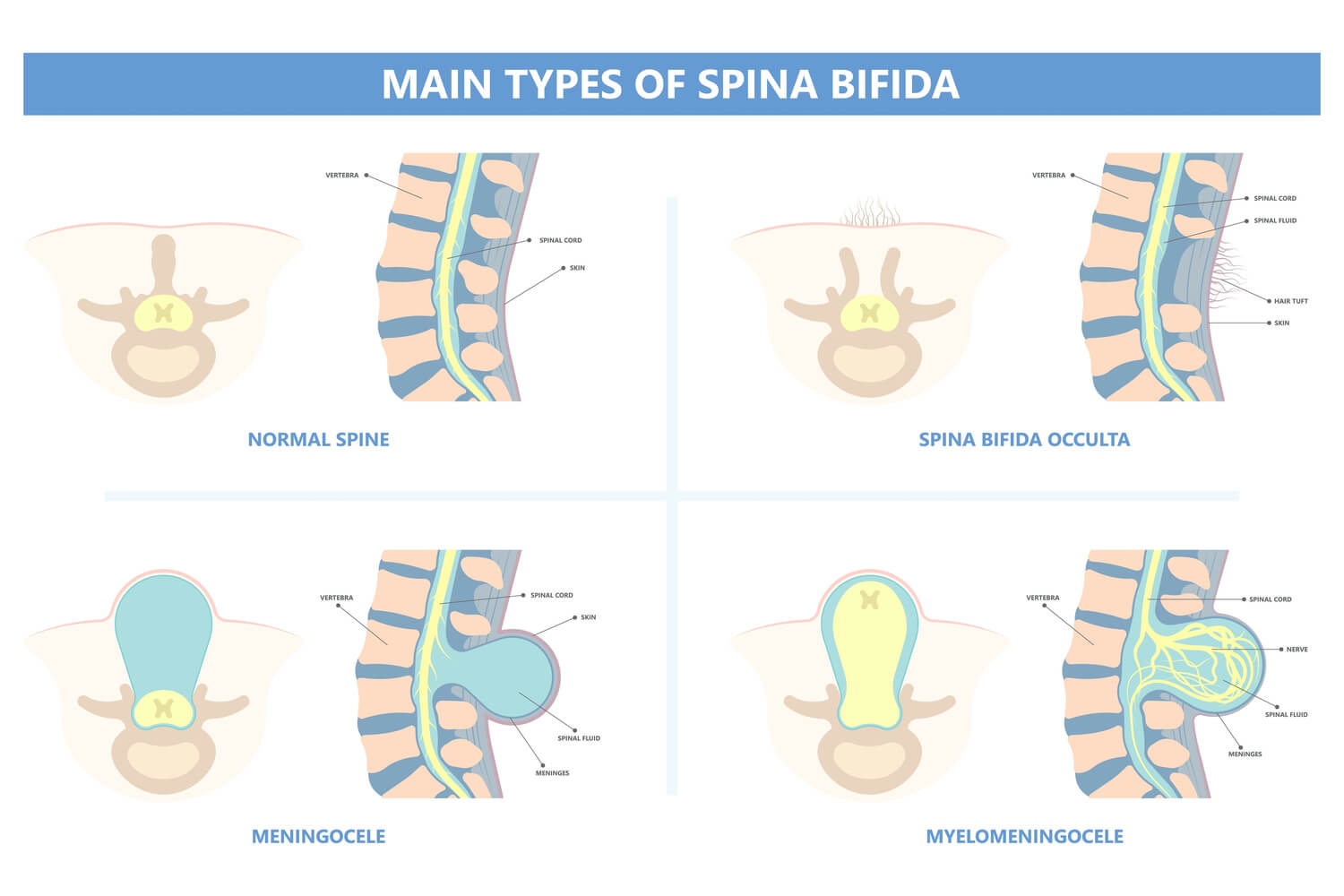 Types of Spina Bifida