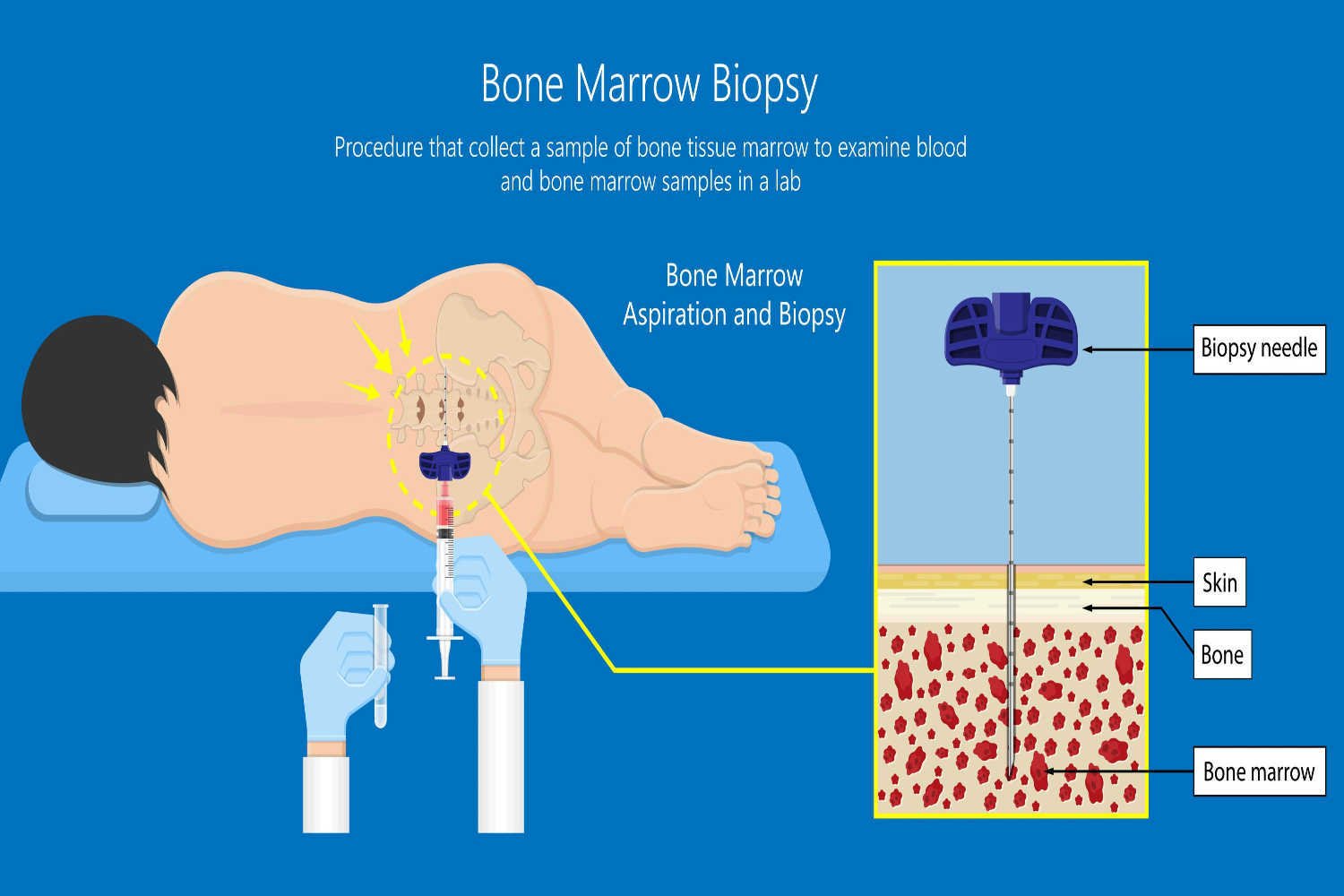 Bone Marrow Biopsy