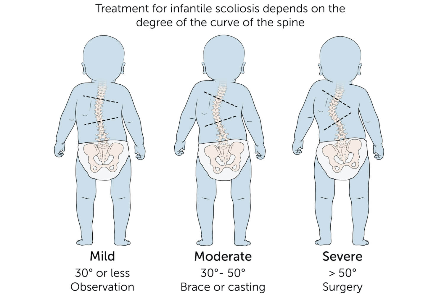Treatment For Infantile Scoliosis