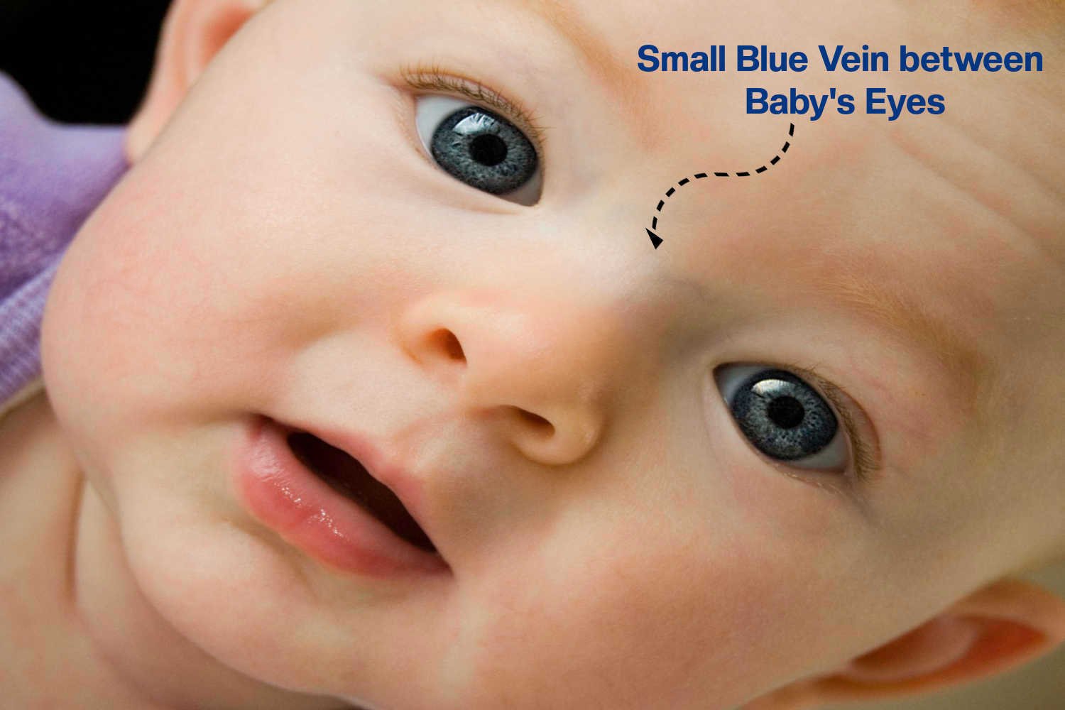 sugar bug vein