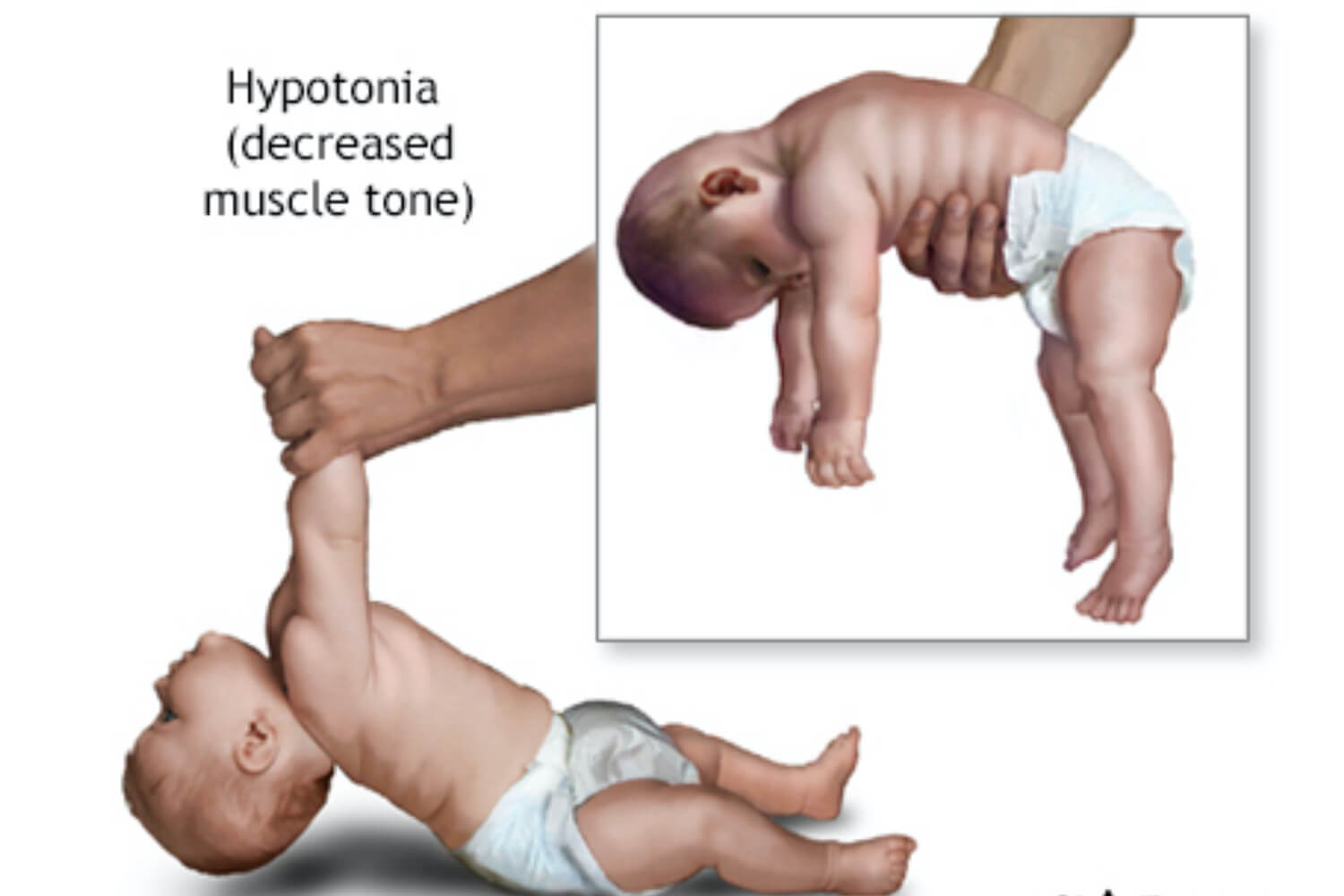 Hypotonia Look Like in Babies