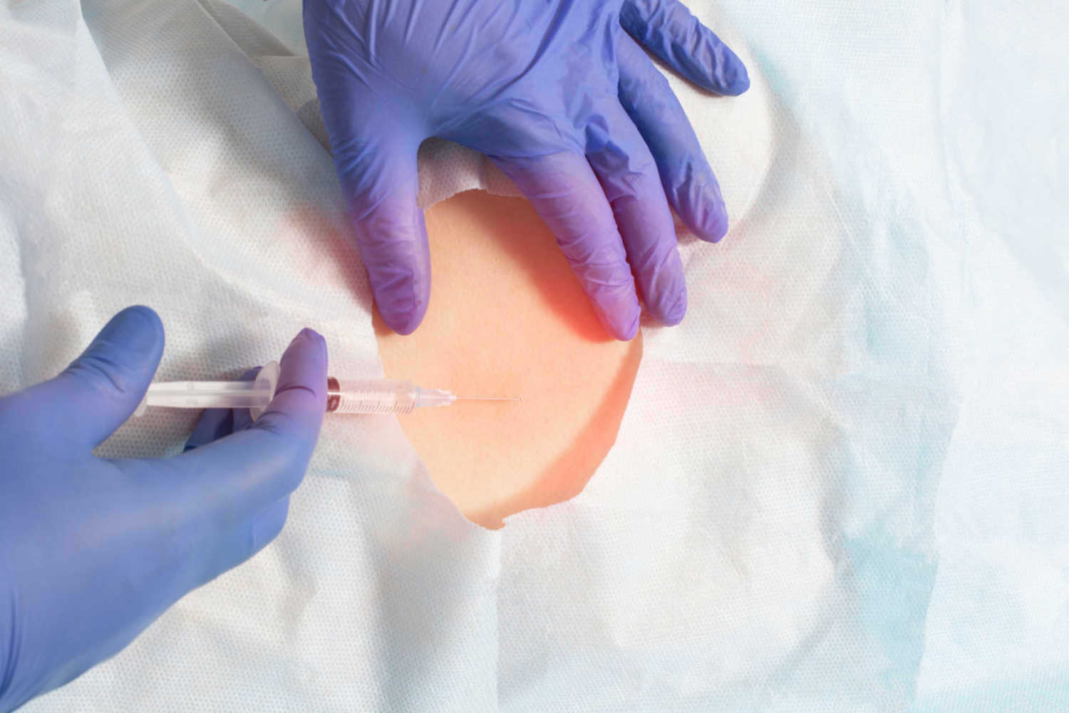 Antenatal Corticosteroid Treatment