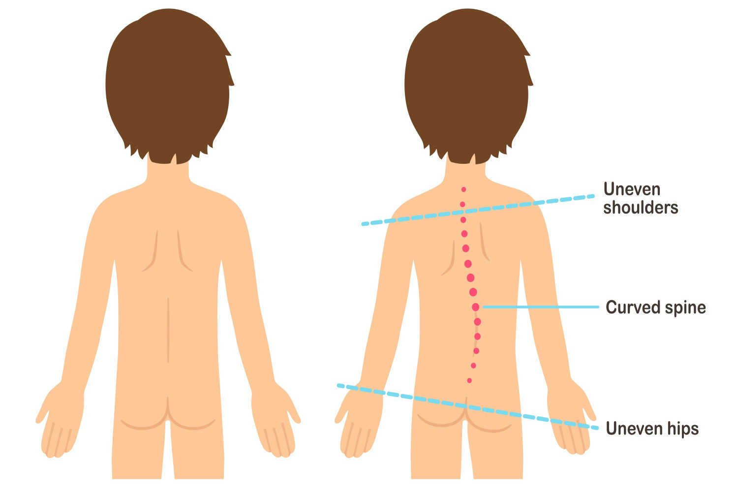 Signs of Infantile Scoliosis