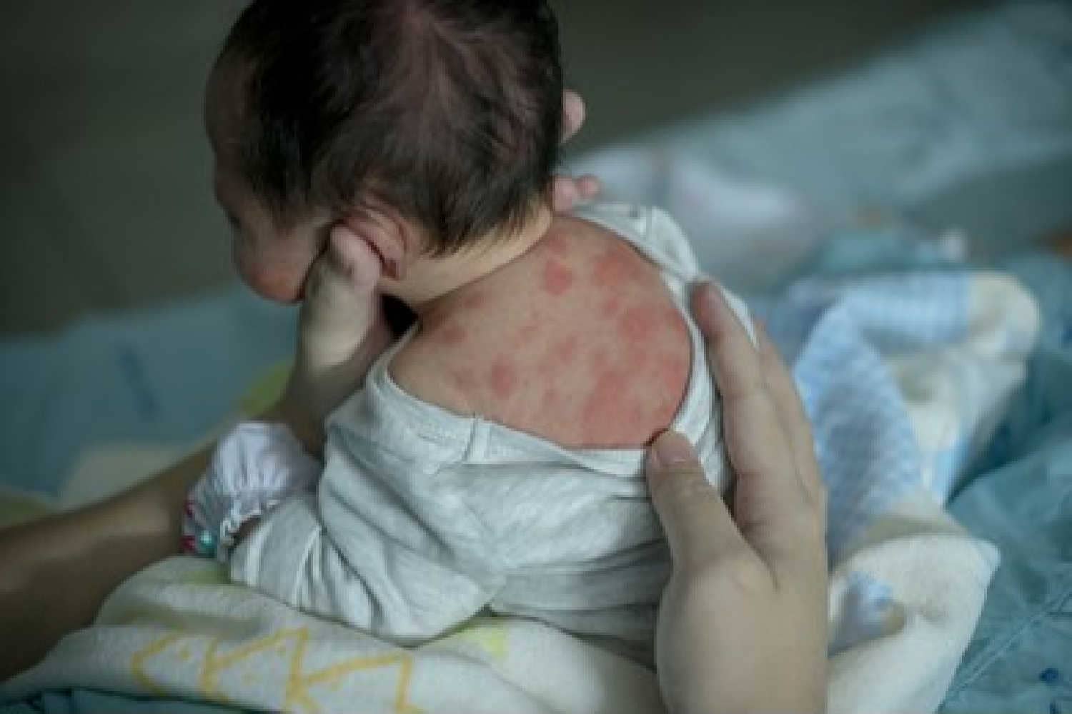 Newborn Eczema Causes, Symptoms And Treatment Being The Parent